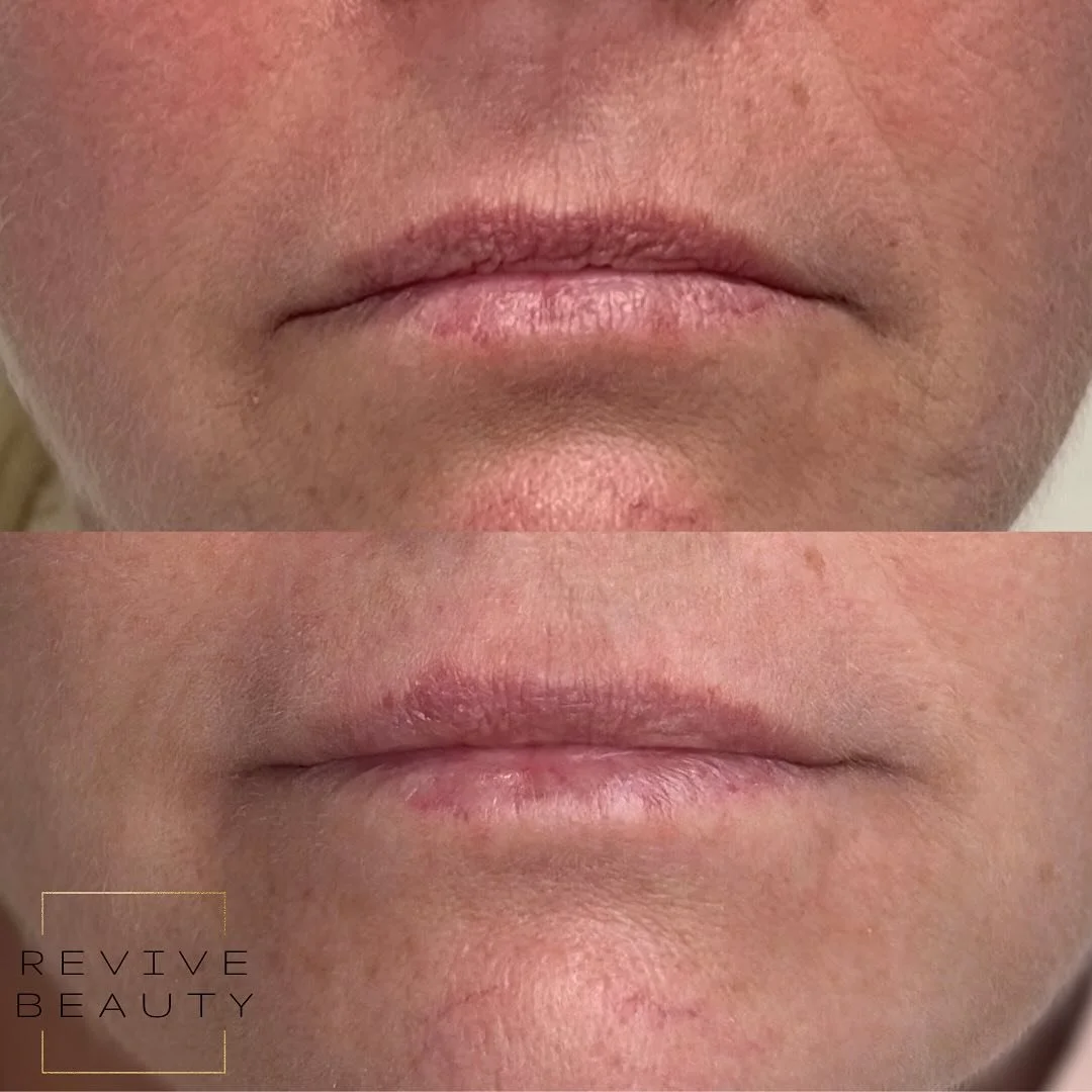 Always look like you&rsquo;re frowning &mdash; even when you&rsquo;re not? 😩

We call that DAO overactivity.
Just 10 units of Botox can relax those muscles and subtly lift your corners for a more refreshed, happy look 💫

#DAObotox #BotoxResults #Na