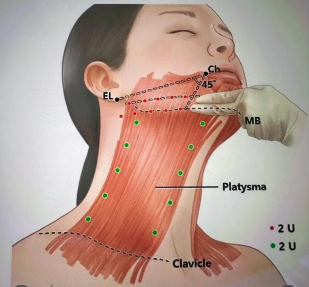 The secret to a perfectly snatched jawline isn&rsquo;t filler &mdash; it&rsquo;s precision tox placement 💉
By treating the DAO, platysmal bands, and platysmal sheath, we relax the downward pull on the lower face &mdash; creating a smoother, lifted, 