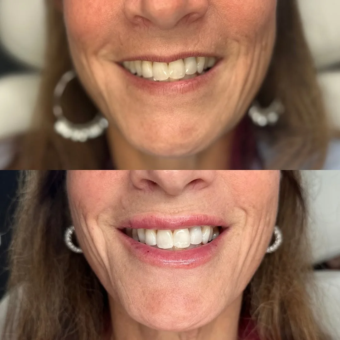 Lip filler isn&rsquo;t just about volume &mdash; it&rsquo;s about function.

Your lips should move naturally when you smile, speak, or laugh.
The goal? Soft, balanced volume that enhances your beauty without ever looking &ldquo;done.&rdquo; 💉✨

#Lip