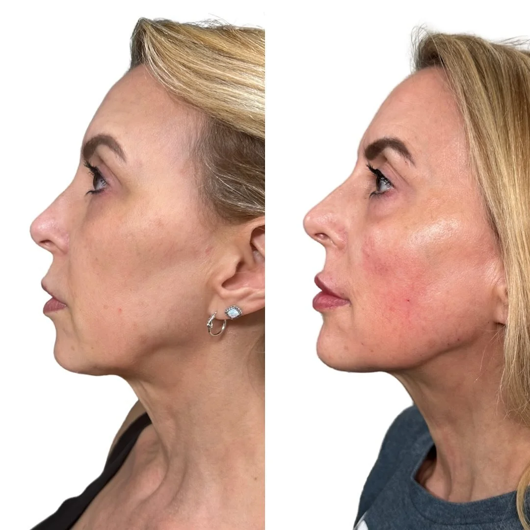 ⚠️Hormonal aging = accelerated jawbone atrophy, especially in women.
When the bony base shrinks, the jawline softens and tissues descend.

💉 Filler is the ultimate corrector because it replaces that lost foundation, re-establishing contour and lift.