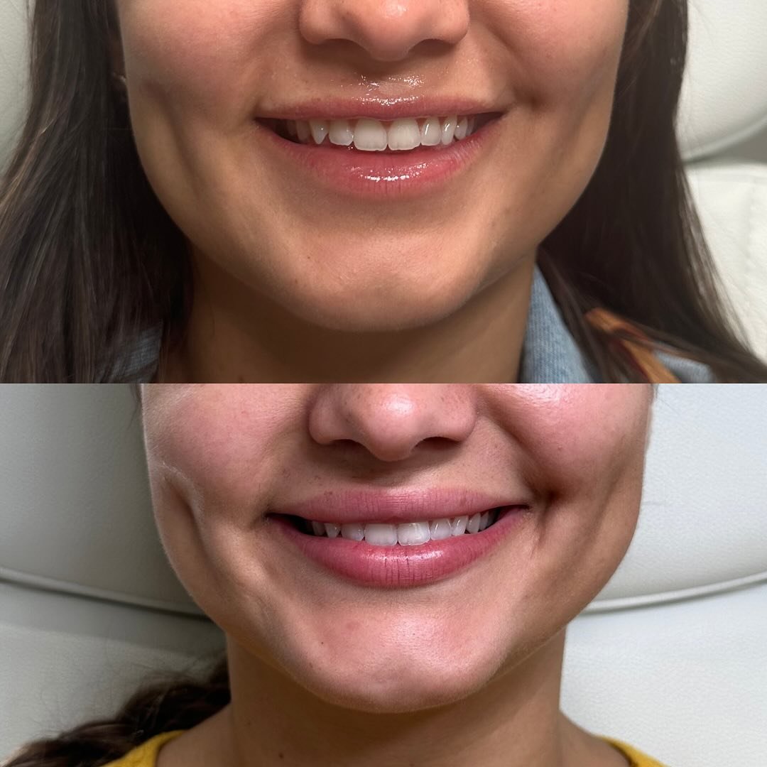 ✨ Lip Flip 101 ✨
If you want a fuller-looking smile without added volume, a lip flip is your new best friend &mdash; and the result with 8 units of Xeomin here is absolutely gorgeous. 💋✨

Perfect for a disappearing smile, subtle definition, and a na