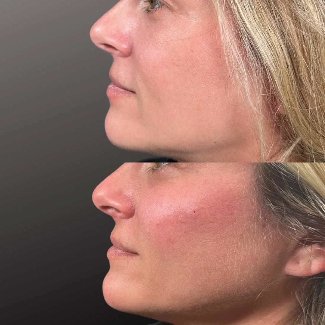 💫 Proper PLACEMENT is everything.

Strategically placed cheek filler supports the midface, improves under-eye hollowing, and restores lift &mdash; which can also soften the appearance of lower-face jowling.

To further balance her features, subtle c