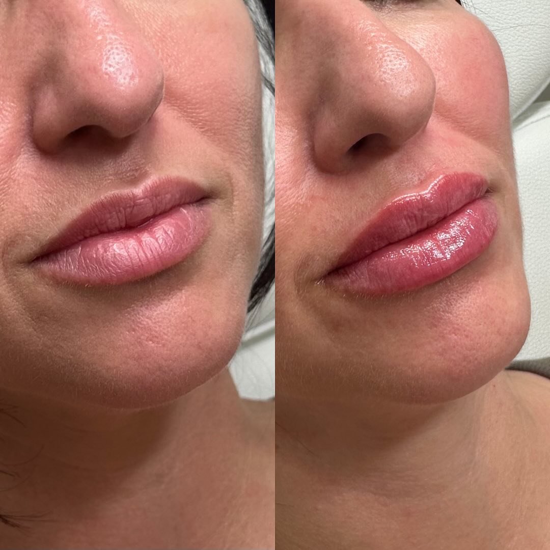🌹 Roses are red, violets are blue 💙,
natural lips are in&mdash;overdone is through 

Everyone deserves a beautiful, natural lip filler result for Valentine&rsquo;s Day and everyday

#lipfillers #lipfiller #fillers #injectables #lipenhancement #lipa