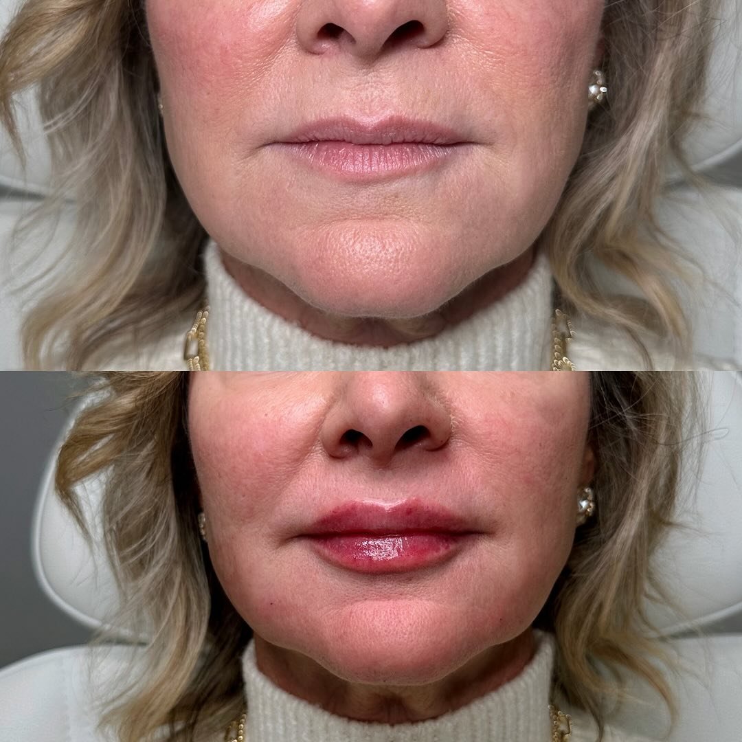 🌹 Roses are red, violets are blue&hellip;
natural lips can be true 💋

This beautiful patient is almost 60 🤫&mdash;but you&rsquo;d never know.
With youthful, tastefully natural lips, she&rsquo;s looking closer to 40 than ever before.

This is the u