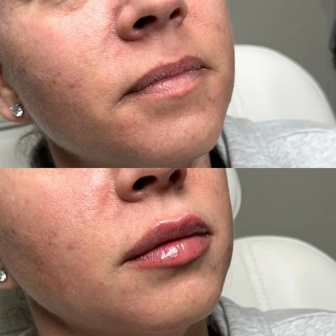 I am dreaming about these PERFECT 💋 

When product, technique, and anatomy align
This is the result.
And yes&mdash;I&rsquo;m in love.

#LipFiller
#NaturalLips
#LipGoals
#LipEnhancement
#AestheticInjector