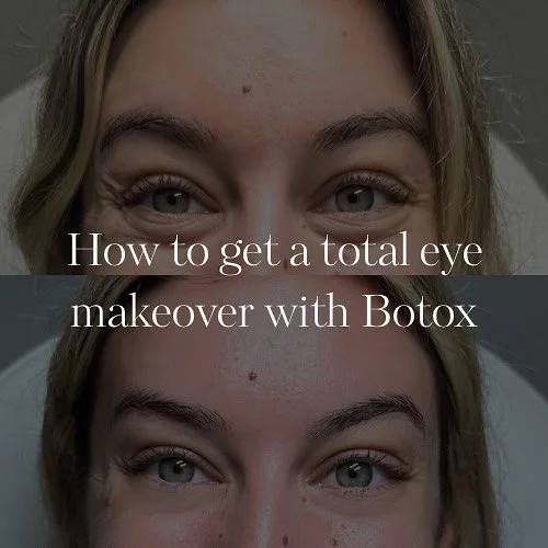 The Complete Eye Makeover (with Botox) 💉✨

A true eye rejuvenation isn&rsquo;t about chasing lines.
It&rsquo;s about understanding muscle balance &mdash; elevators vs. depressors &mdash; and placing toxin with intention.

Here&rsquo;s what that look