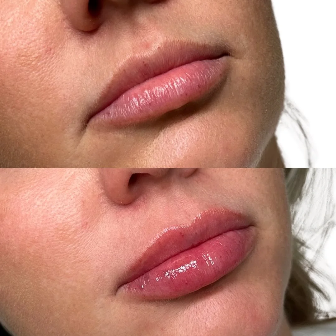 This is what precision, technique, and proper product choice look like. 💉✨

Refined.
Elegant.
And uniquely her.

Beautiful lips aren&rsquo;t about overfilling&mdash;they&rsquo;re about respecting anatomy and placing product with intention. The goal 