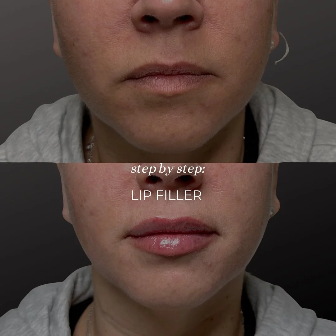 Swipe for my step by step guide on how to choose the right product for you lip filler patients 👉🏻

Natural lip filler isn&rsquo;t about adding volume &mdash; it&rsquo;s about restoring structure, hydration, and shape.

In this patient I focused on 