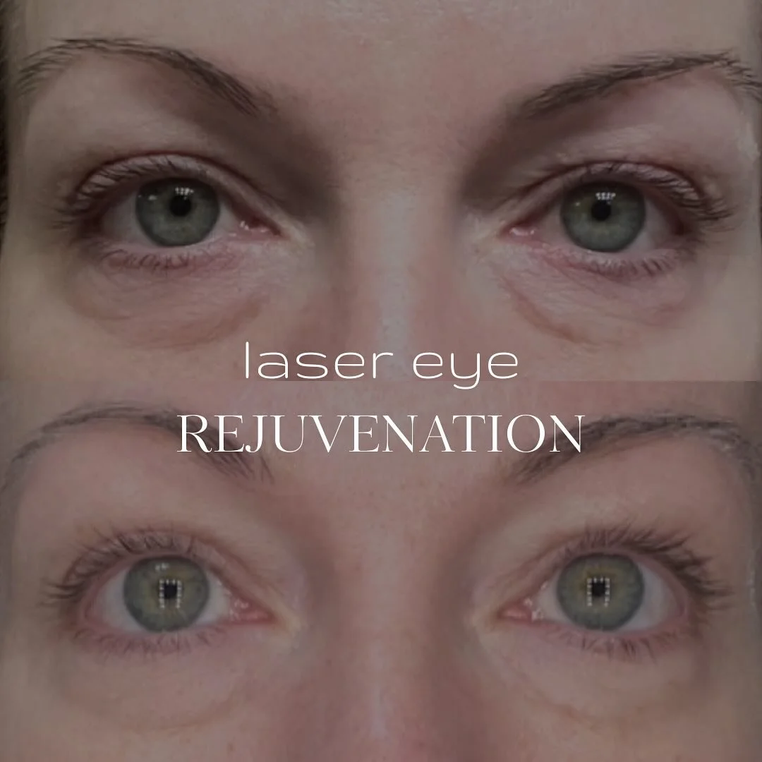 Fotona SmoothEye ✨

A non-invasive approach to upper and lower eyelid rejuvenation with no surgery and no downtime.

Using Fotona&rsquo;s patented Er:YAG SMOOTH&reg; technology, controlled thermal pulses stimulate collagen remodeling to tighten and s