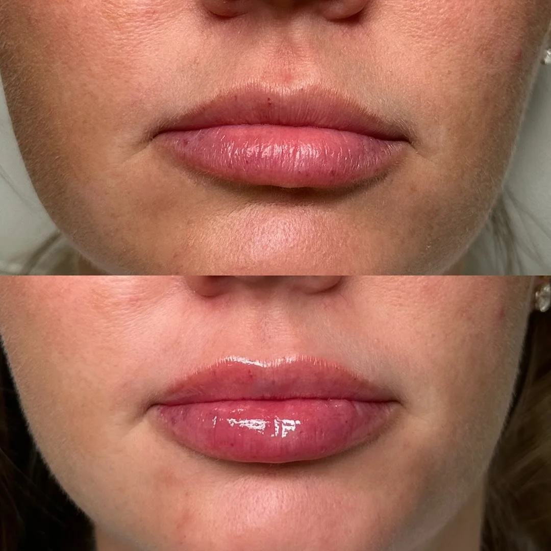 She looks like you.
Acts like you.
Reminds you of who she used to be&hellip;

Just elevated. ✨

Natural lip enhancement.

Still 🤤 over this transformation