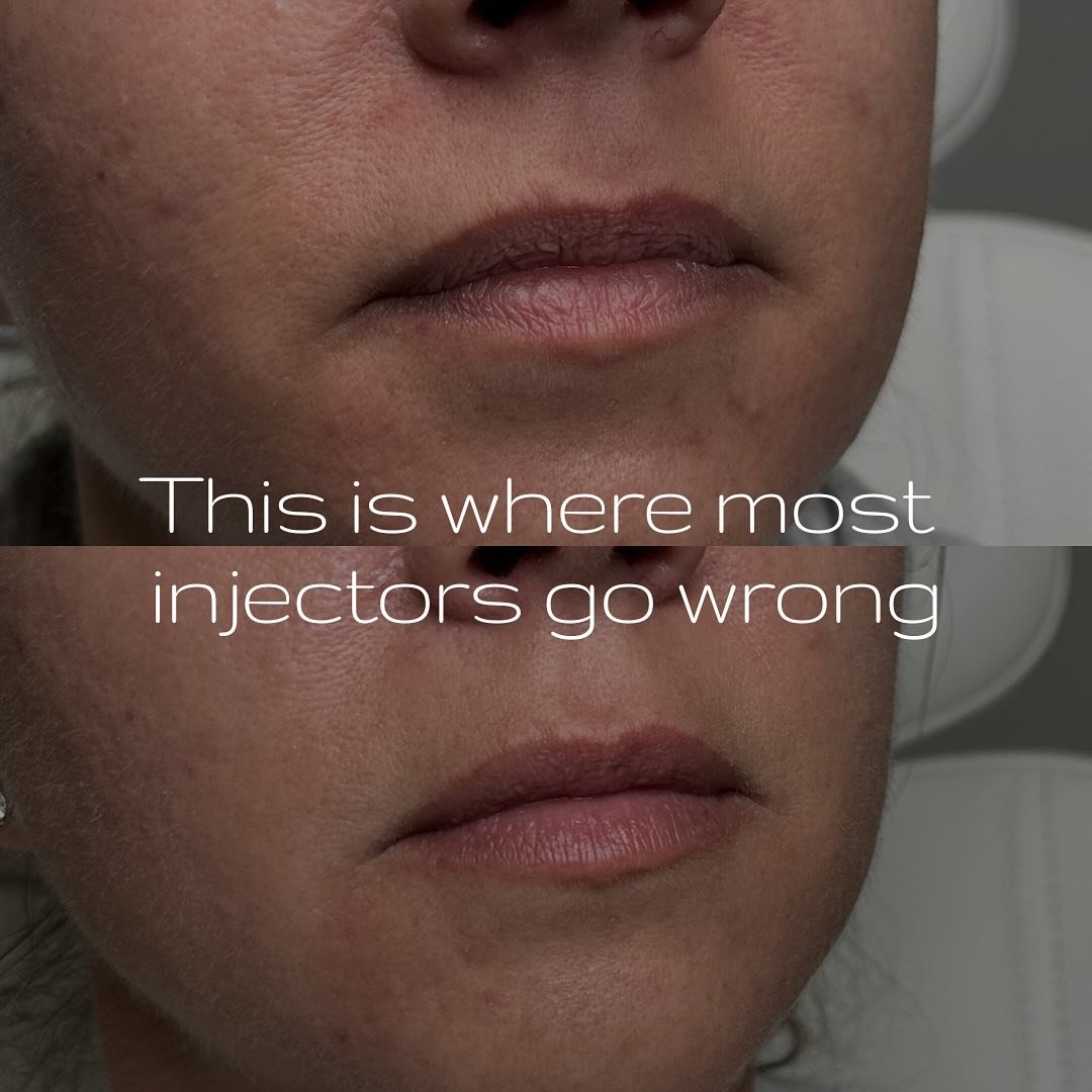 Everyone wants volume&hellip;
But this is why I don&rsquo;t start there.

This was the beginning of her lip journey.
We had a clear goal: more height, better structure, long-lasting volume.

But instead of rushing, we started with foundation.

Sessio