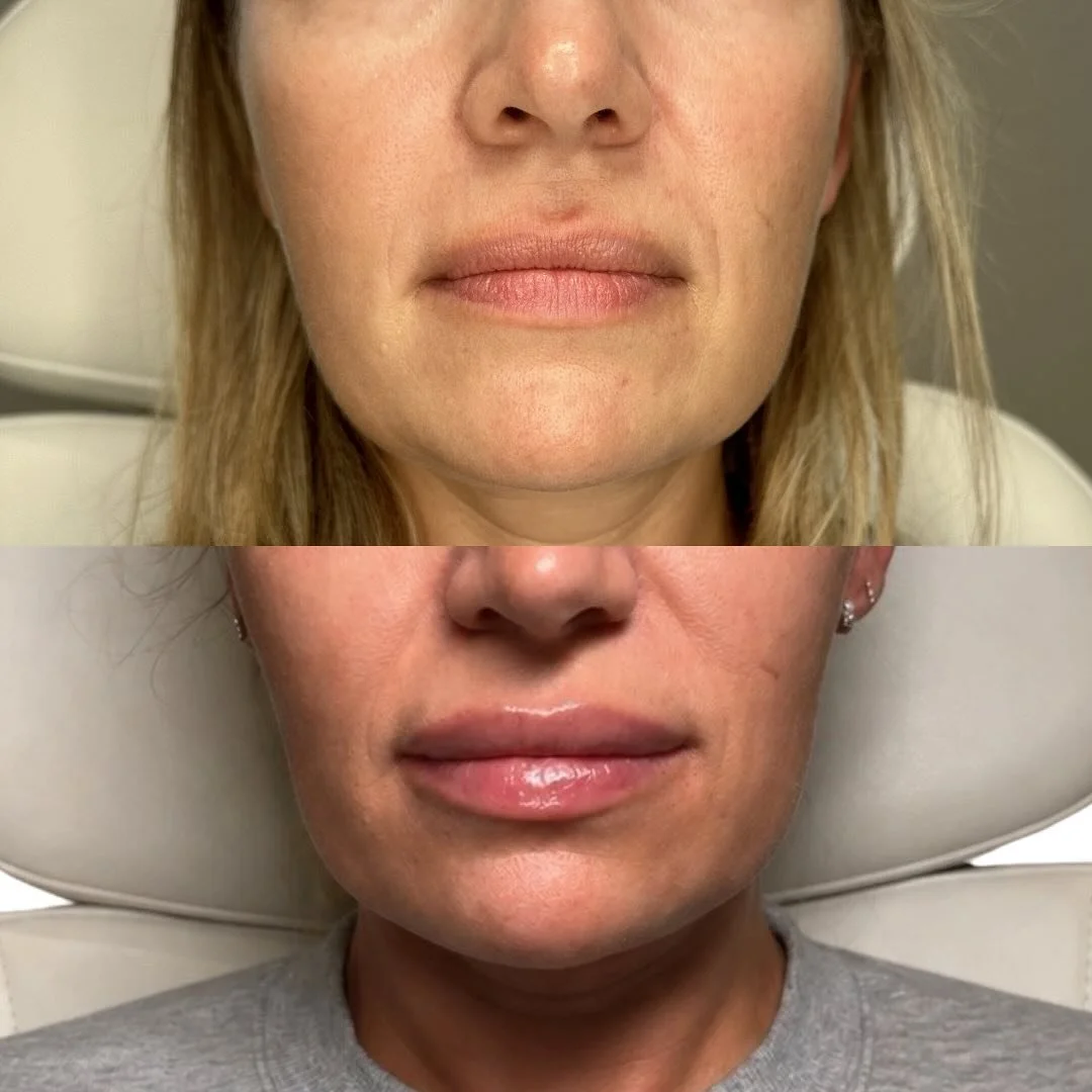 W&bull;O&bull;W 🤯

 Before: a poorly defined vermilion, and a bit of crepiness&mdash;aging the lips instead of enhancing them. 

Fast forward to the &lsquo;after&rsquo;&mdash;a subtle, hydrated look that&rsquo;s exactly what she needed! 💋 The perfe
