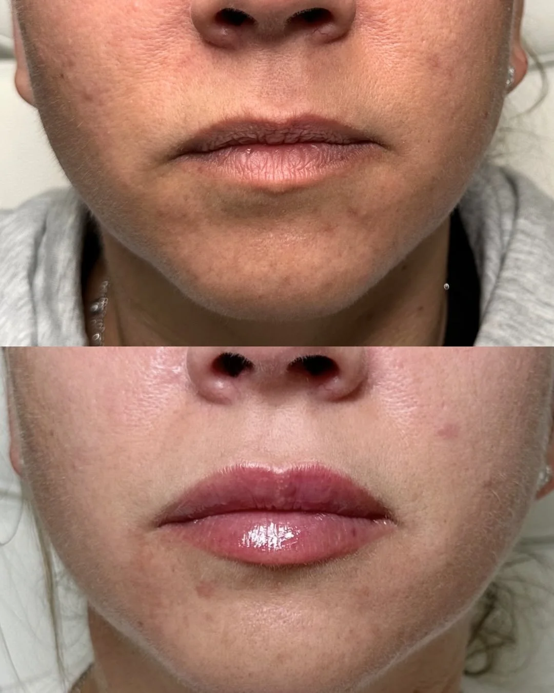 These are the SAME lips from my previous post 👄

And this is exactly why patience + technique matter.

We did NOT try to force this result in one appointment.
This is her SECOND session after first rebuilding the foundation of the lips.

When lips h