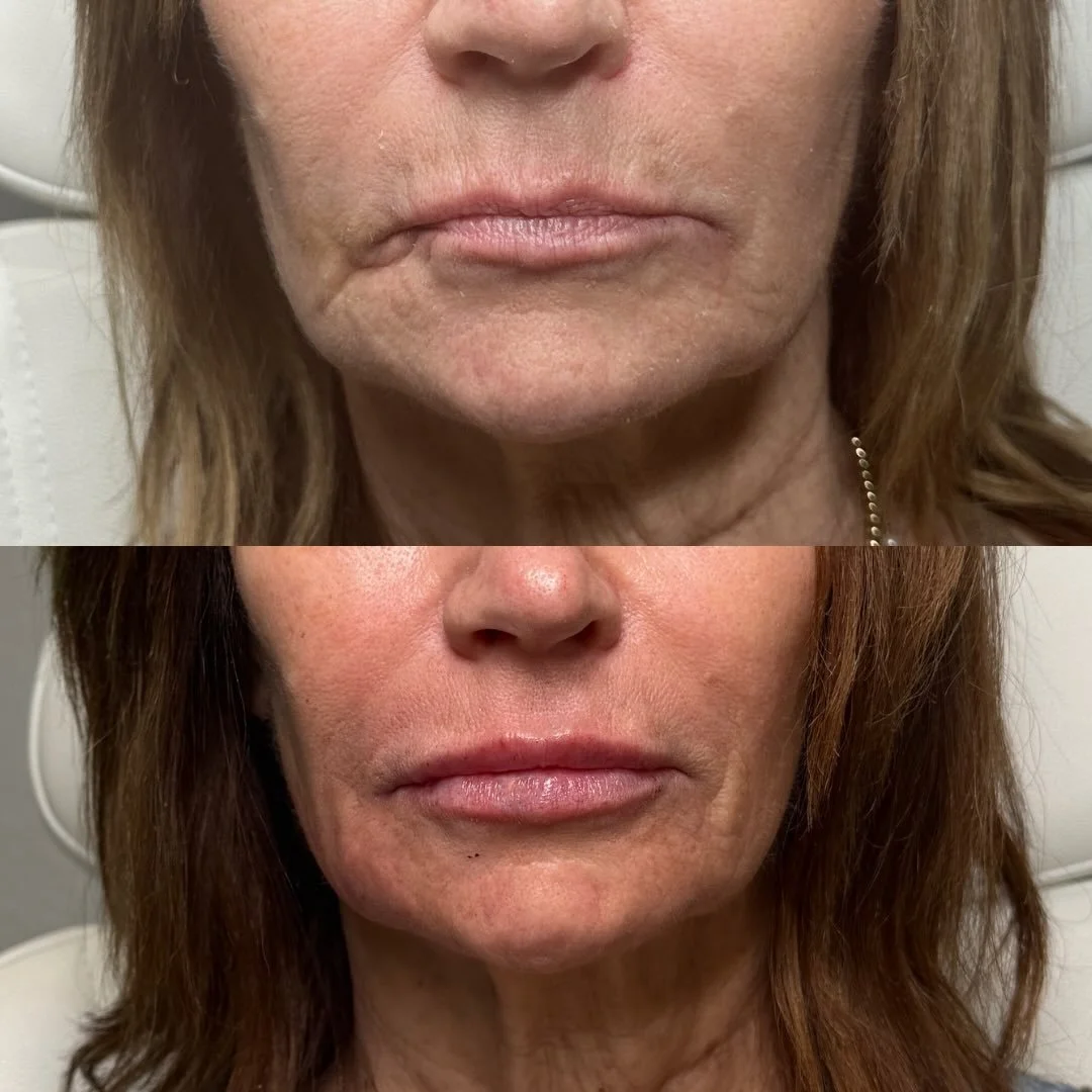 this transformation was never about &ldquo;just lips.&rdquo; ✨
it was about strategically rebuilding support in the lower face.

by treating:
▪️ chin shadow
▪️ pre-jowl sulcus
▪️ age-related volume loss

with the right product at the right time ⏳, we