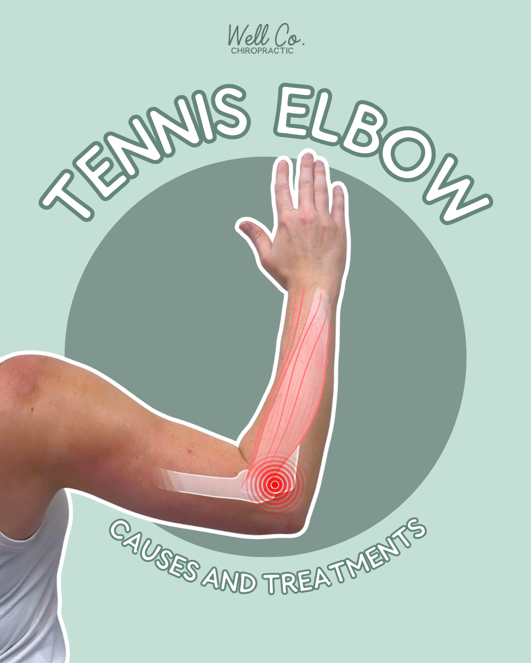 Tennis Elbow Treatment in Sarasota: How Active Release Helps Players Recover, Faster ~