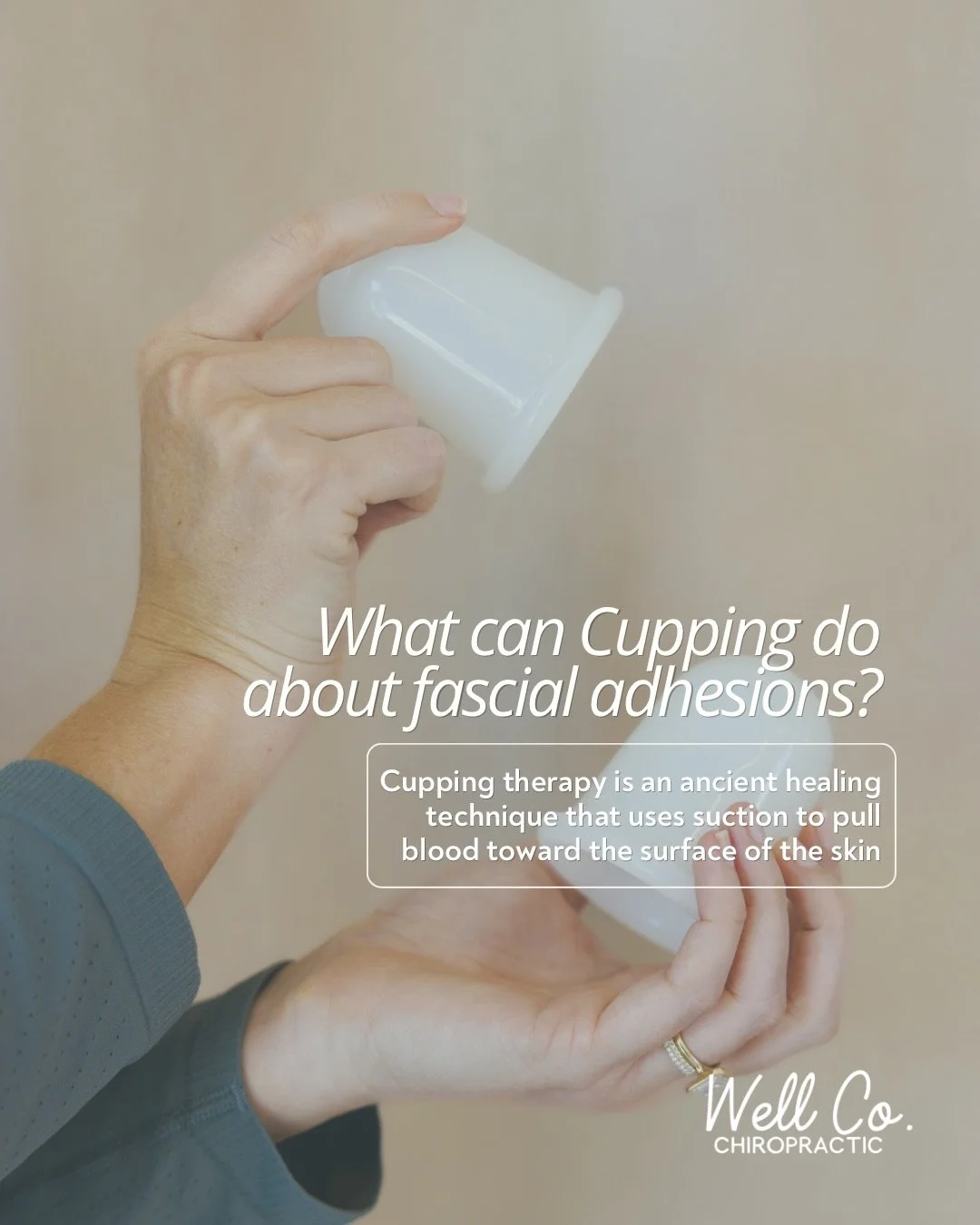 Cupping may look intense, but the goal is simple: improve circulation and reduce tension in overworked muscles.

This ancient therapy uses suction to pull blood toward the surface while helping tight tissue decompress and move better.

#sarasotachiro