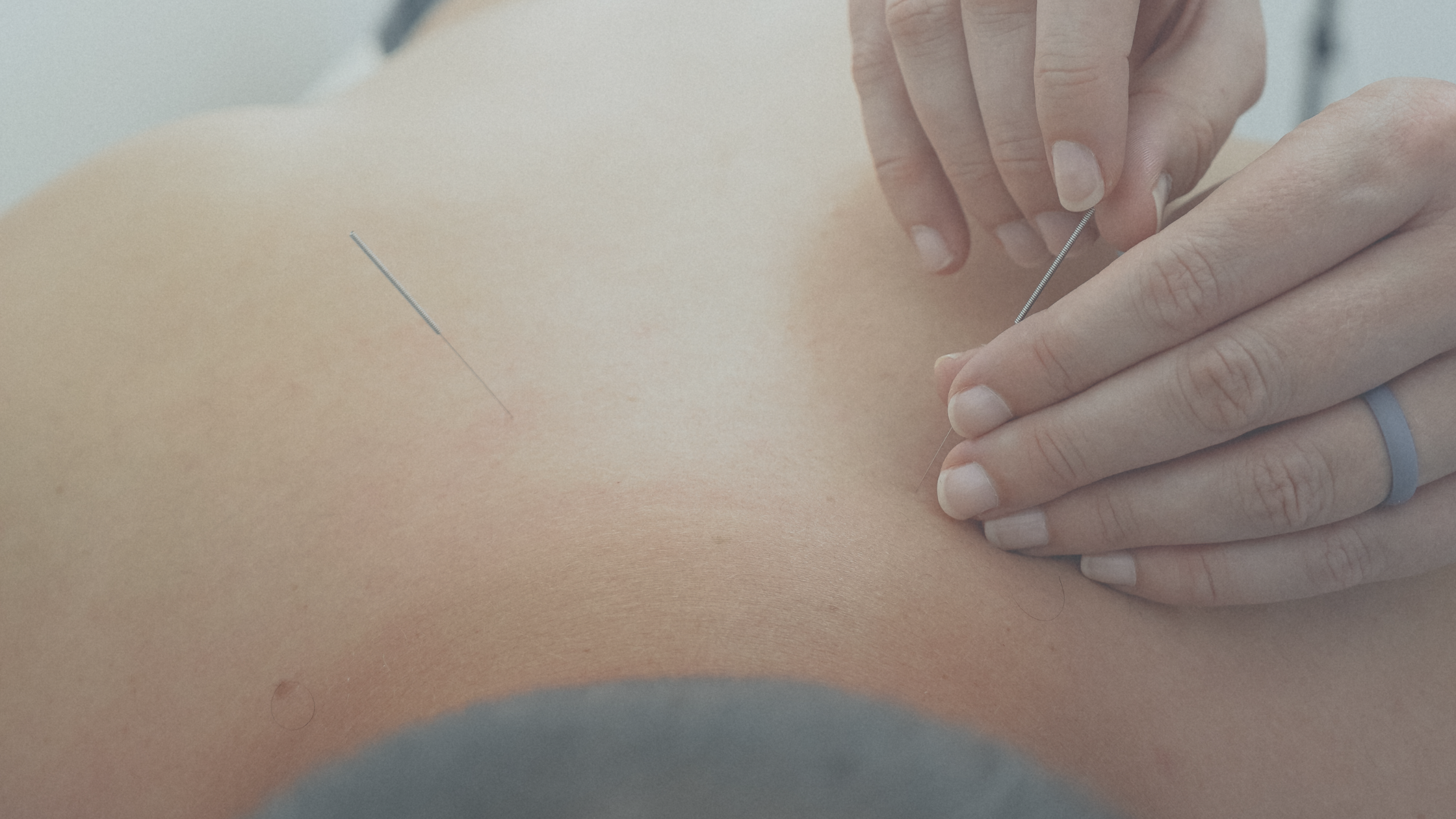 Acupuncture for Labrum tear pain and rehab