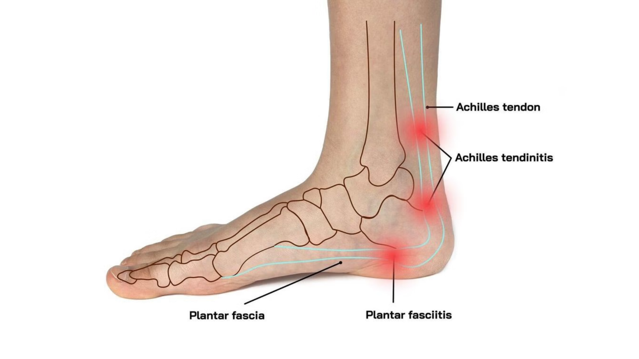 heel pain in Sarasota FL