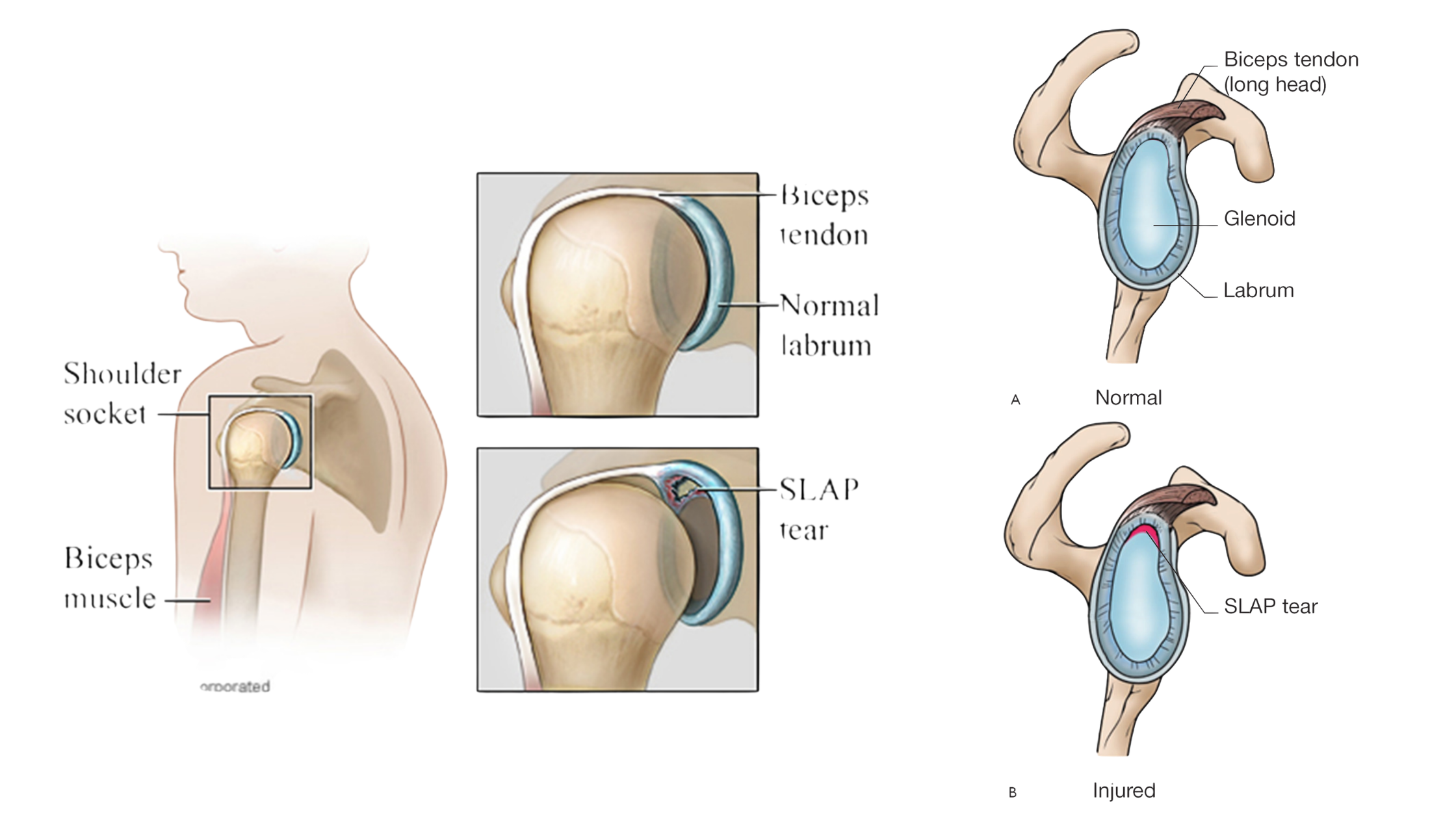 Anatomy of SLAP Tear