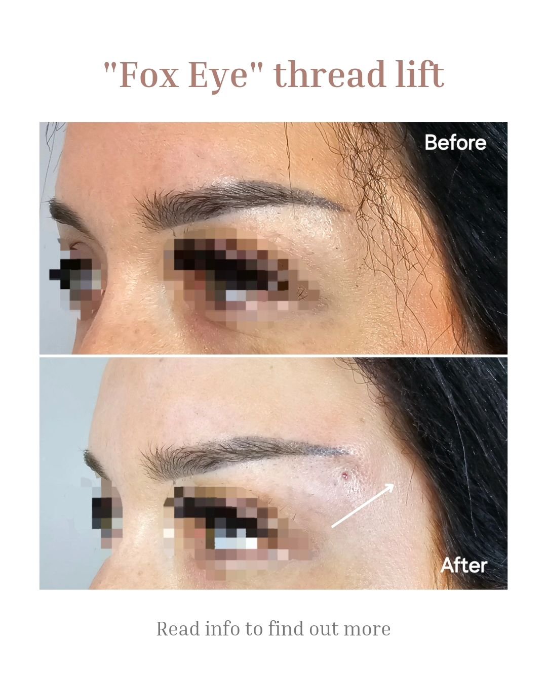 What is a FOX EYE thread lift? 🤔⬇️ 

A &quot;Fox Eye&quot; PDO Thread Lift is a cosmetic procedure designed to lift and shape the eyebrows and outer corners of the eyes. 👁 

It can create a lifted, elongated appearance reminiscent of a fox's eyes. 