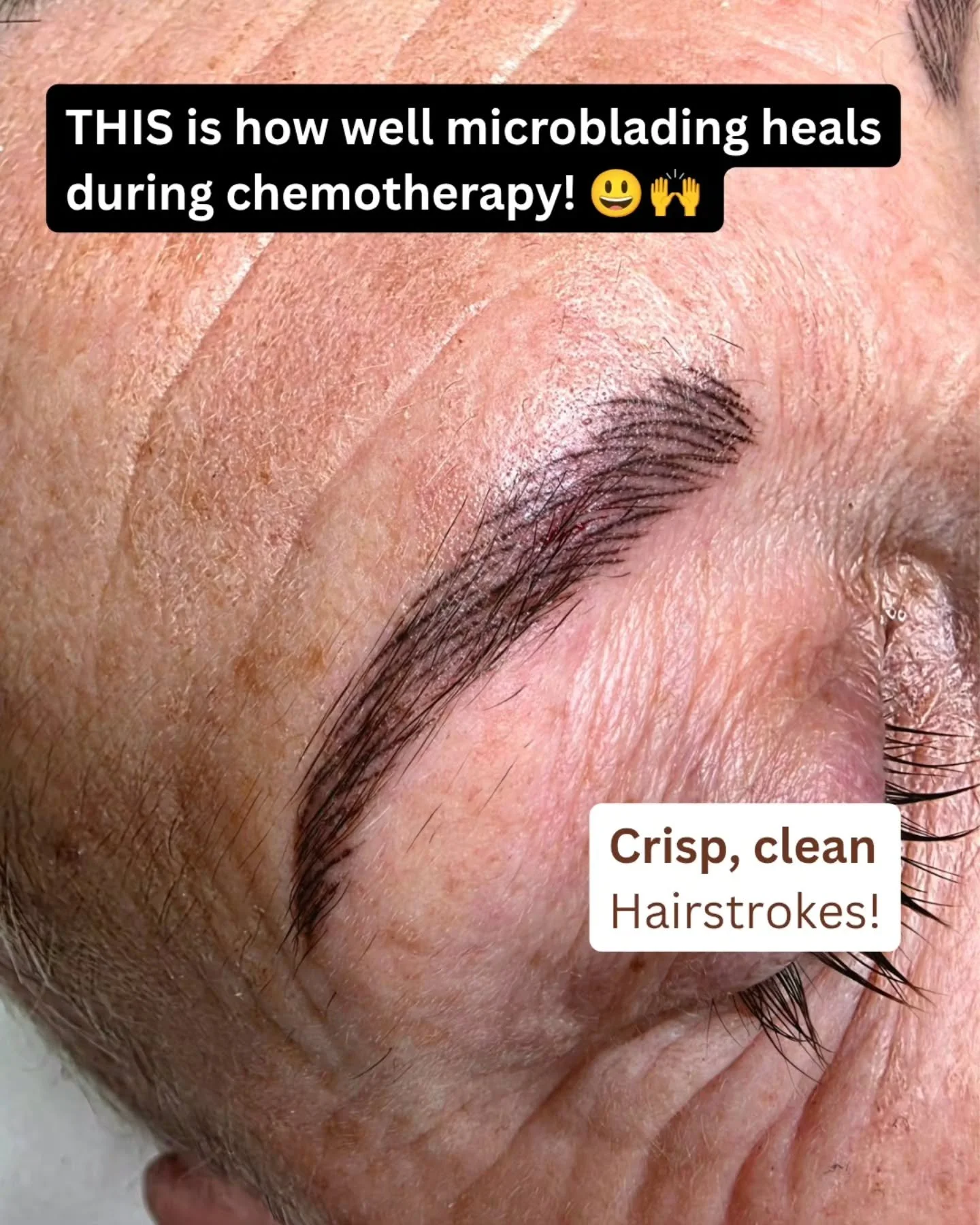 This is PROOF that microblading can heal beautifully, even DURING chemotherapy! 🥰 

MYTH :
❌️ The colour and hairstrokes will NOT heal well 

❌️ The patient is at risk of infection 

TRUTH: 
✅️ I have had AMAZING healed results with EVERY client und