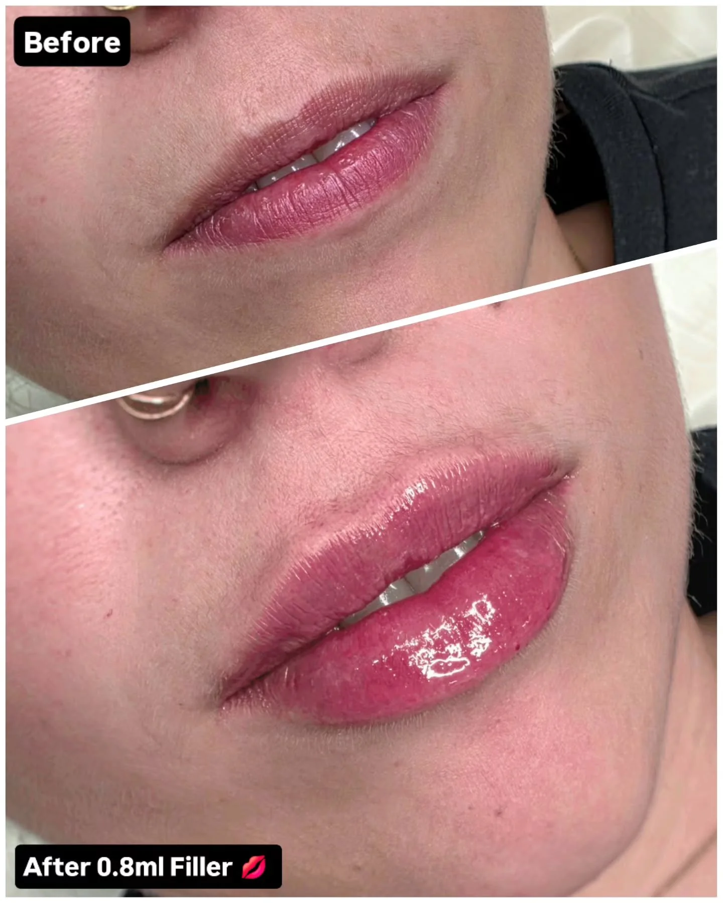 Sometimes... all you need is a little bit 🤏 of filler to add a little bit of plumpness 🍑 to your lips! 💋 

0.5ml usually isn't enough 🙈...

And sometimes, 1ml can be a bit too much! 🫣

But often, somewhere in between 0.5-1ml of filler can be the