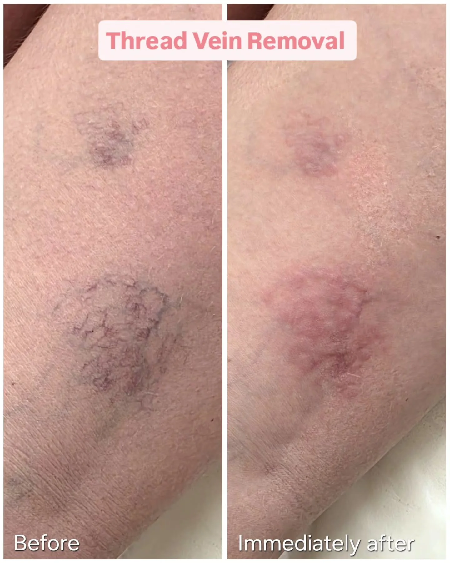 Wow! 😲 Look at these results after just ONE session of Thread Vein Removal! 👌🙌

Thread veins can look unsightly and be embarrassing. 😳

They can appear anywhere, but most commonly can be found on the face (cheeks and around the nose), and on the 