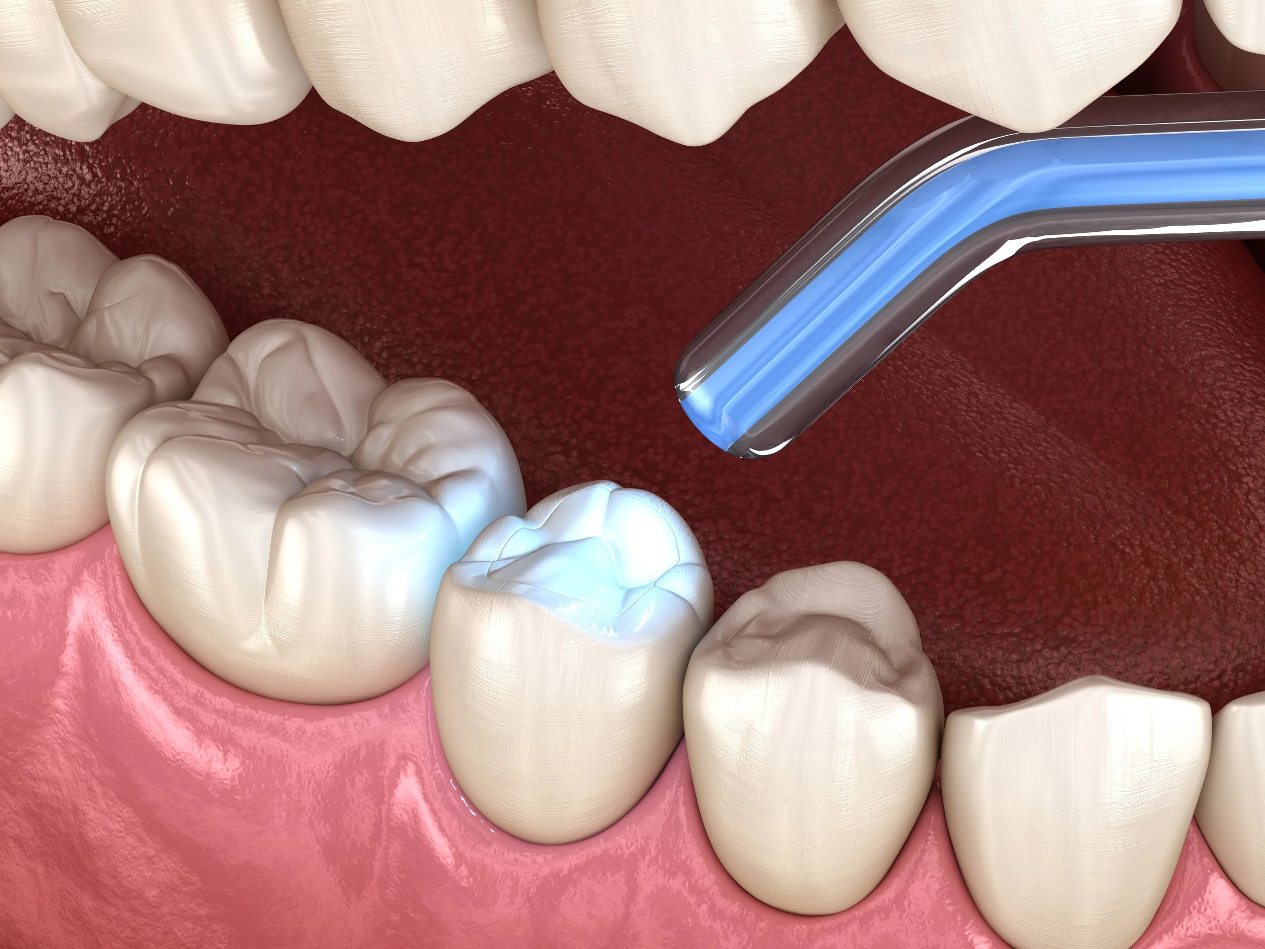 Restorations — Tomahawk Family Dental