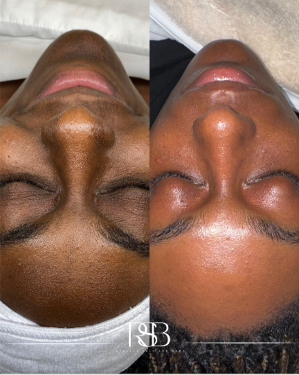 TIER I: ESSENTIAL PIGMENT FACIALS
