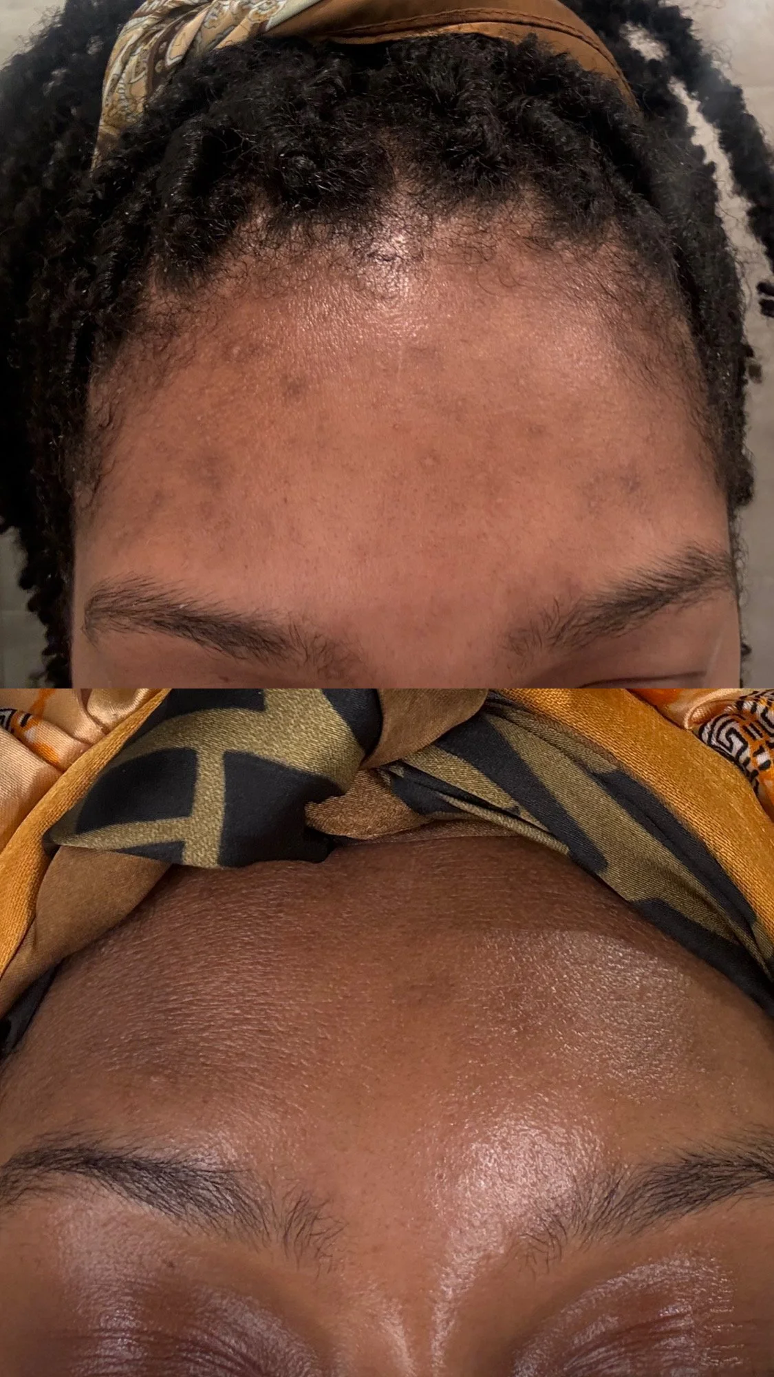TIER I & II: ACNE + PIGMENTATION FACIALS