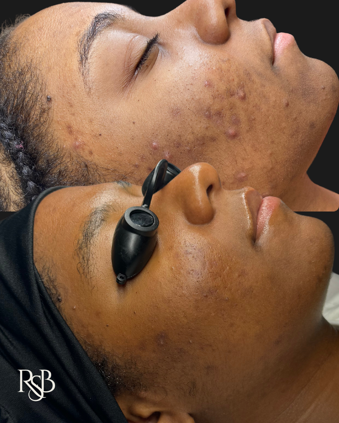 TIER I & II: ACNE FACIALS