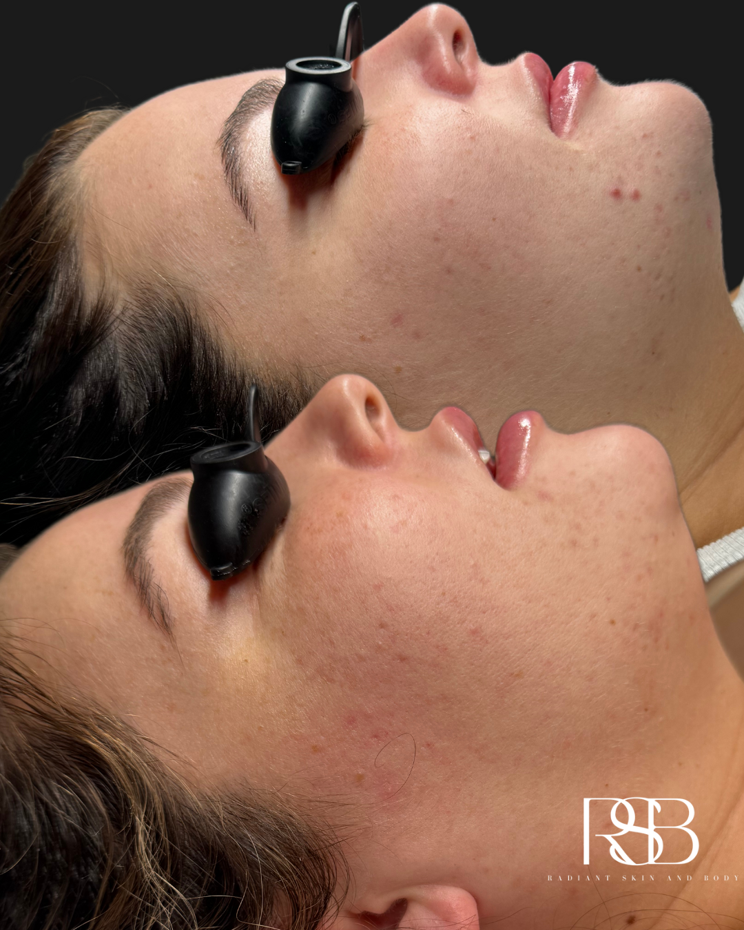 PREGNANCY ACNE BOOTCAMP 