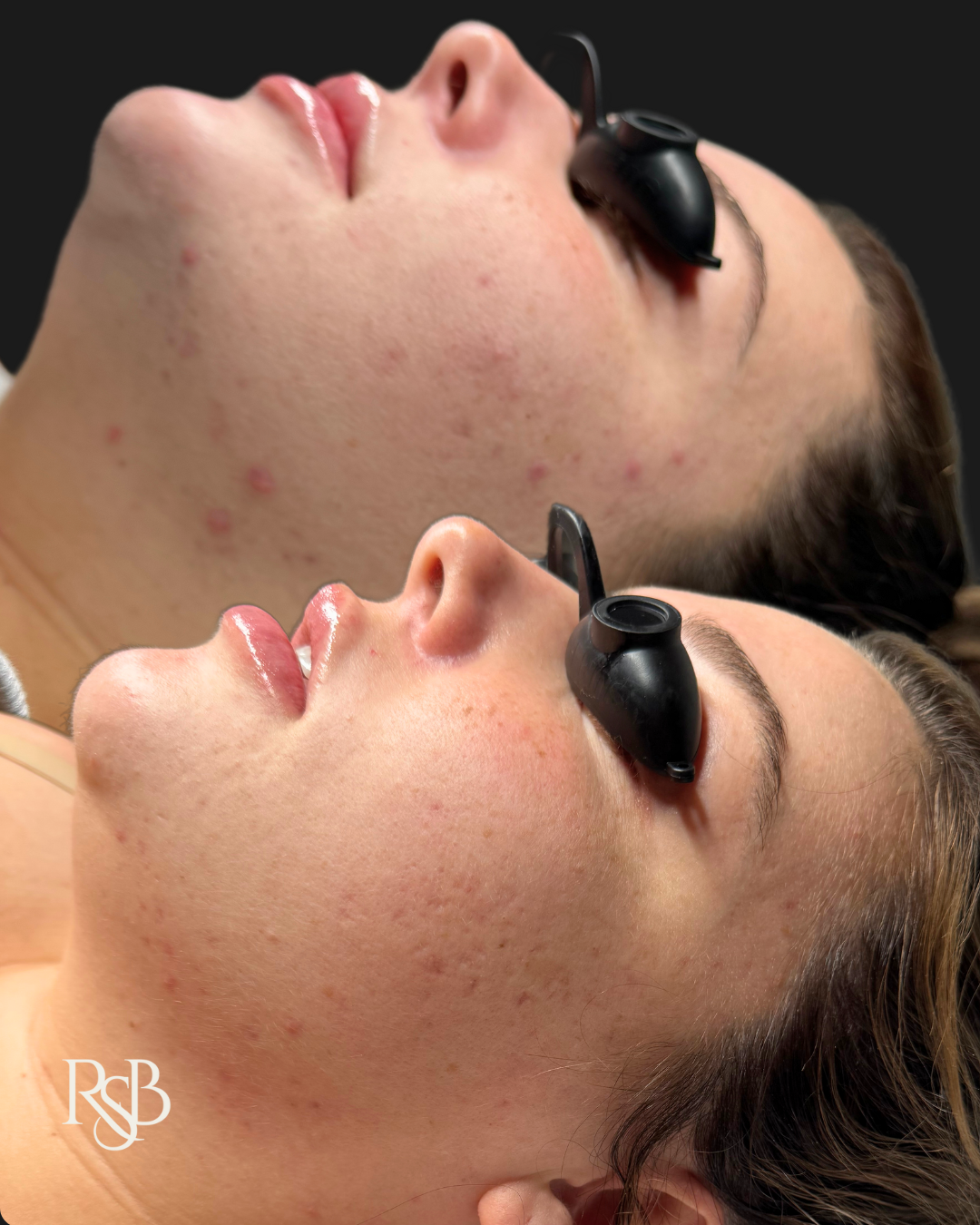 PREGNANCY ACNE BOOTCAMP 