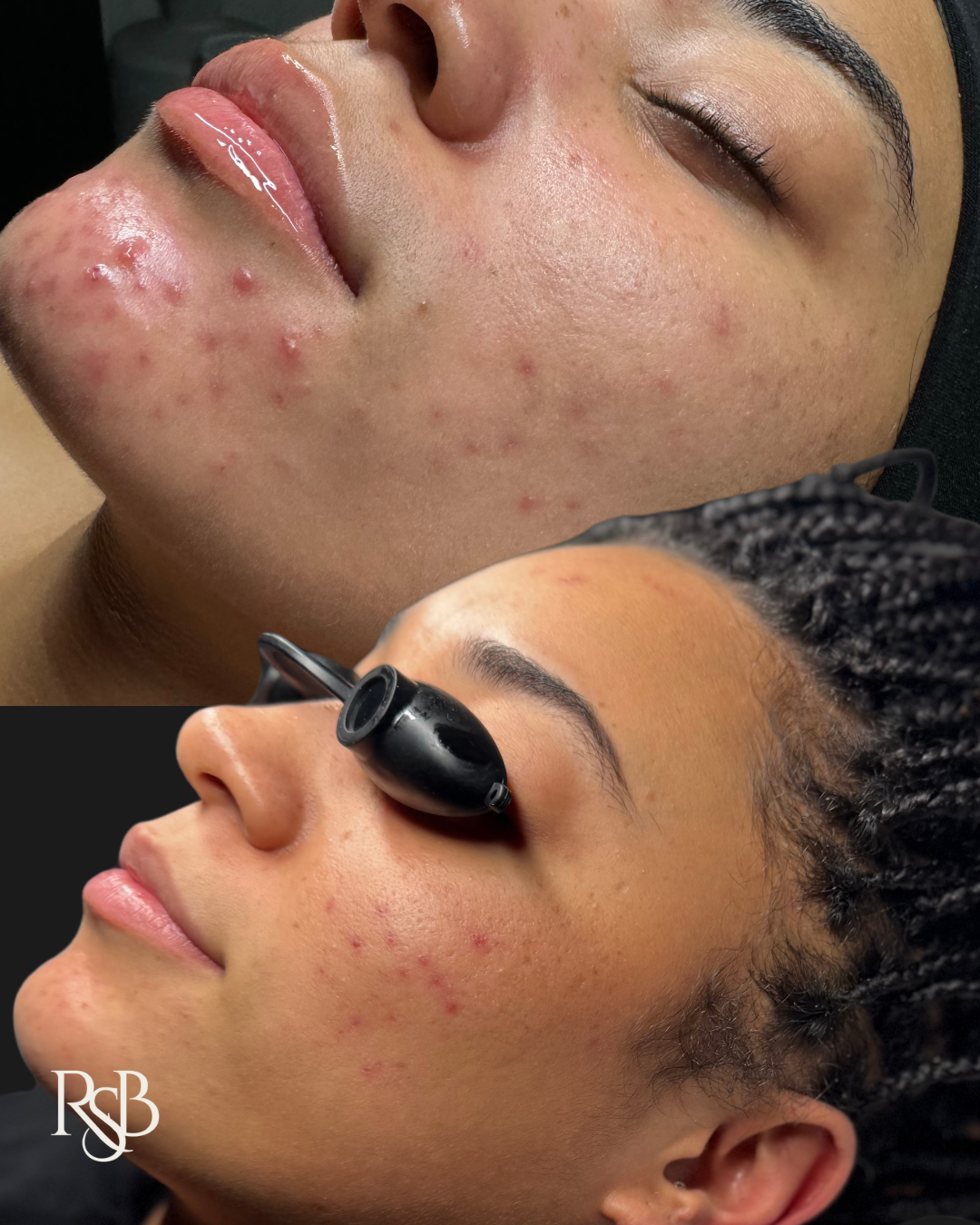 TIER I: ESSENTIAL ACNE FACIAL 