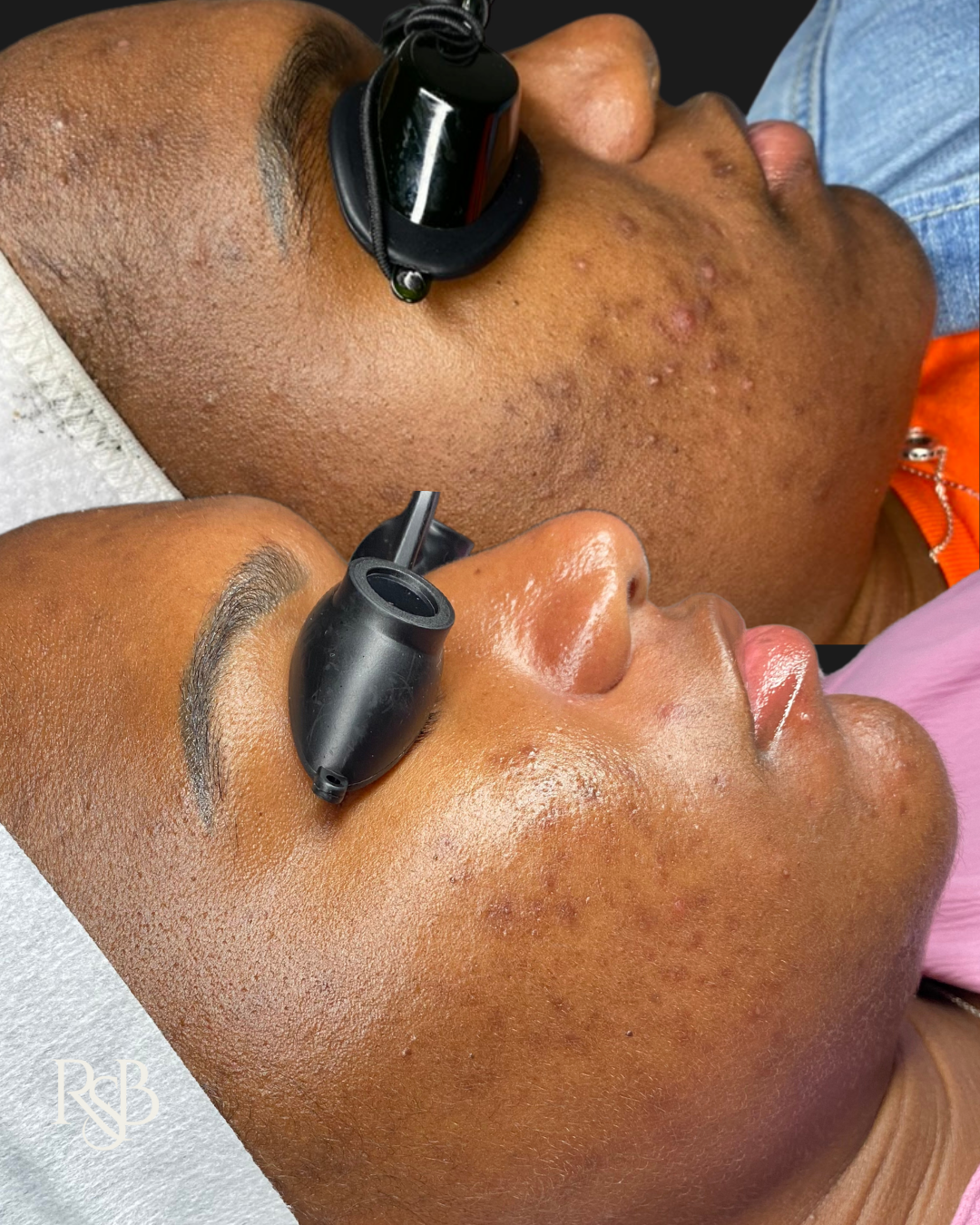 TIER I: ESSENTIAL ACNE FACIALS