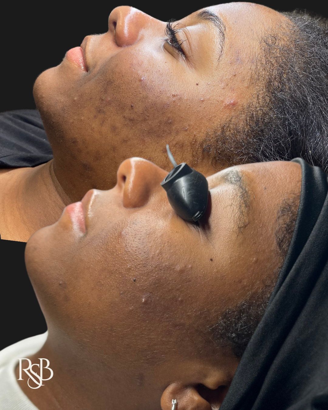 TIER I & II: ACNE FACIALS
