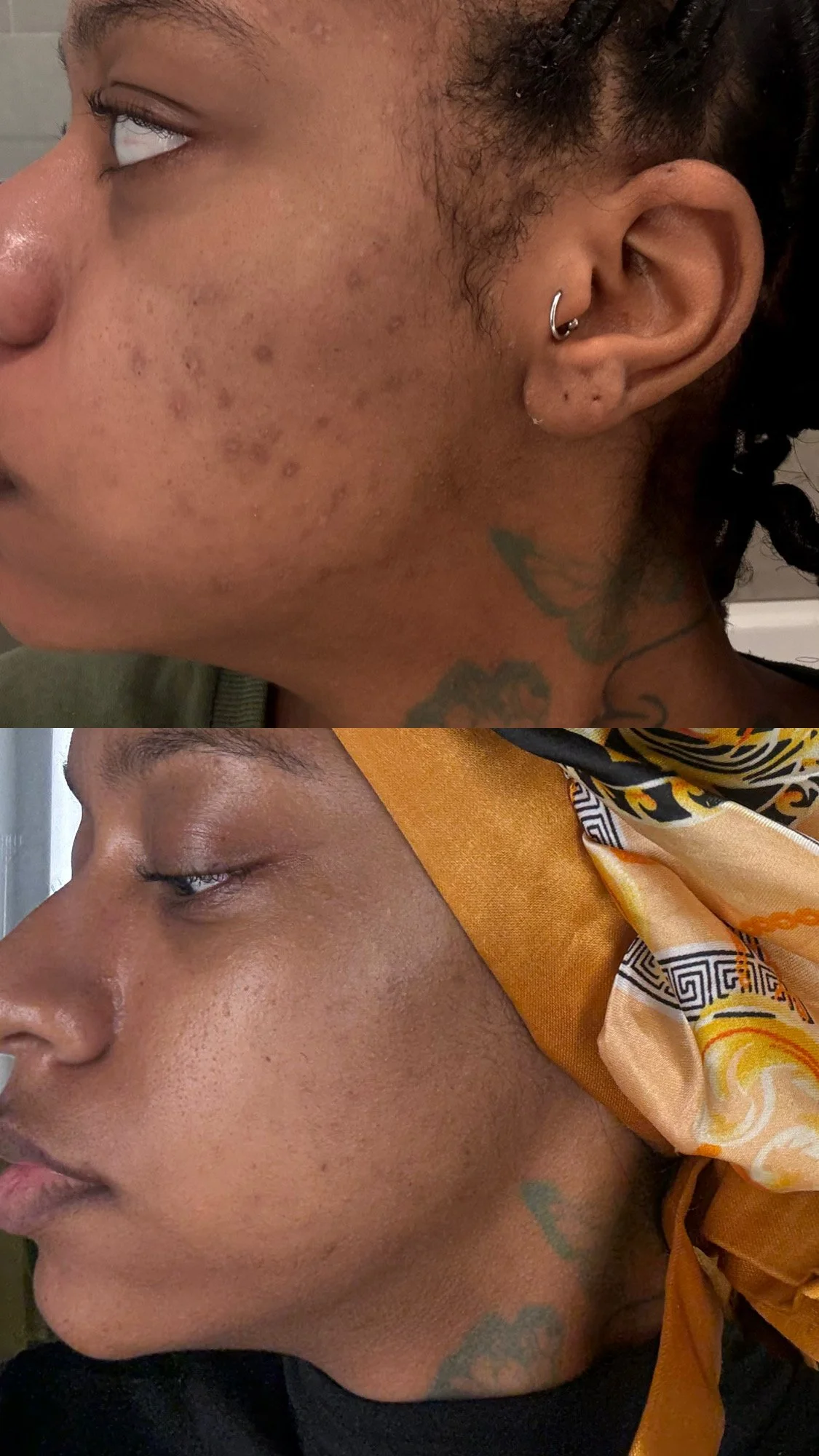 TIER I & II: ACNE + PIGMENTATION FACIALS