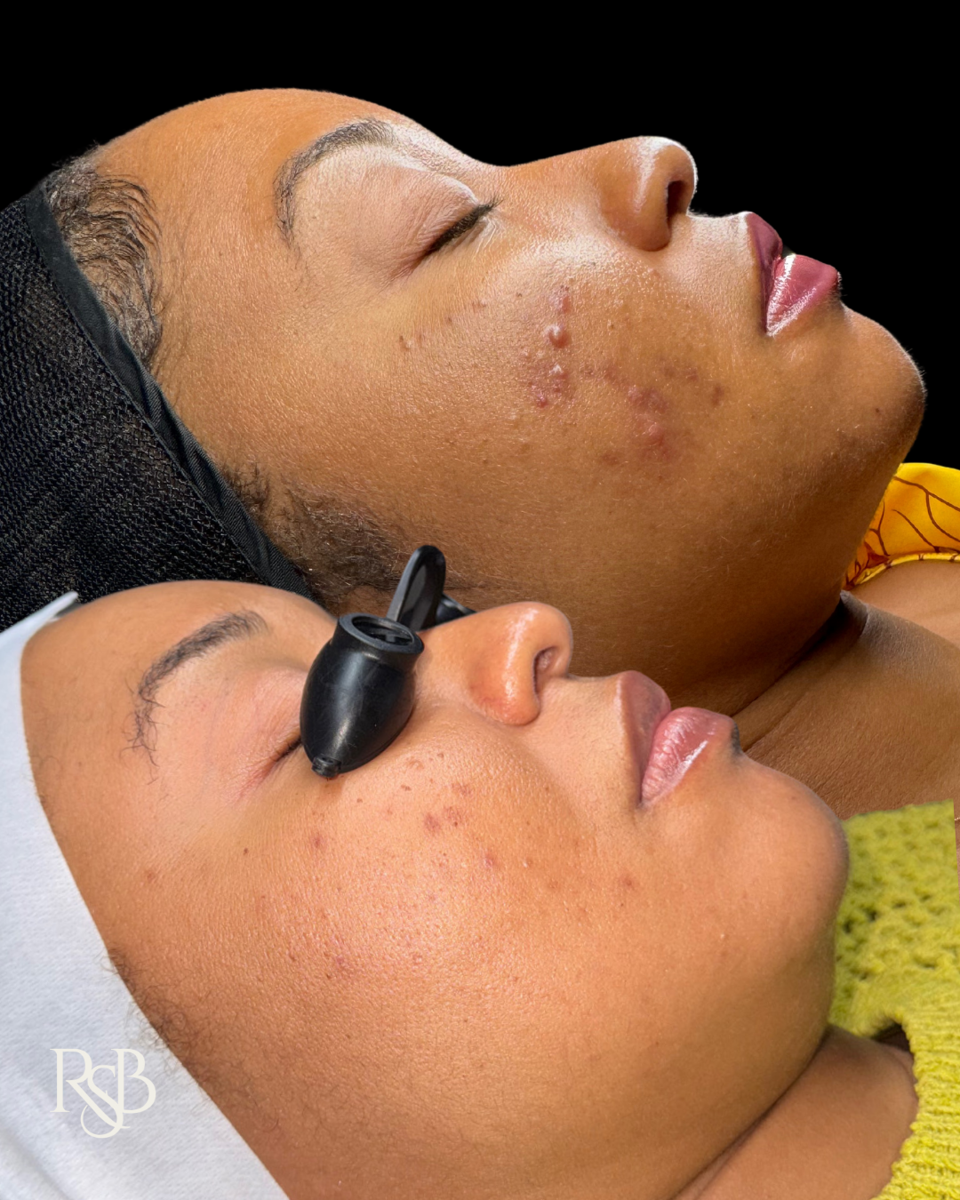 TIER I & II FACIALS 
MICROCHANNELING + CHEMICAL PEELS