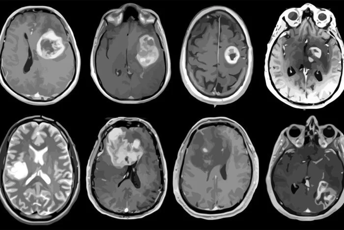 Policy Brief: Strengthening Cancer Data and Research Policy SB 1150 to Address Glioblastoma