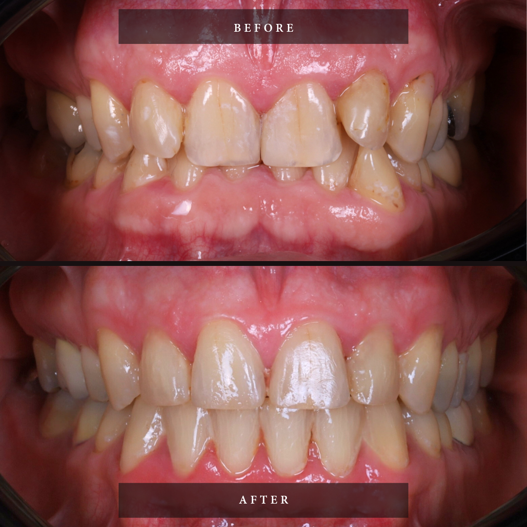Comprehensive Orthodontic treatment for adult done by NYC orthodontist Sean Yoon