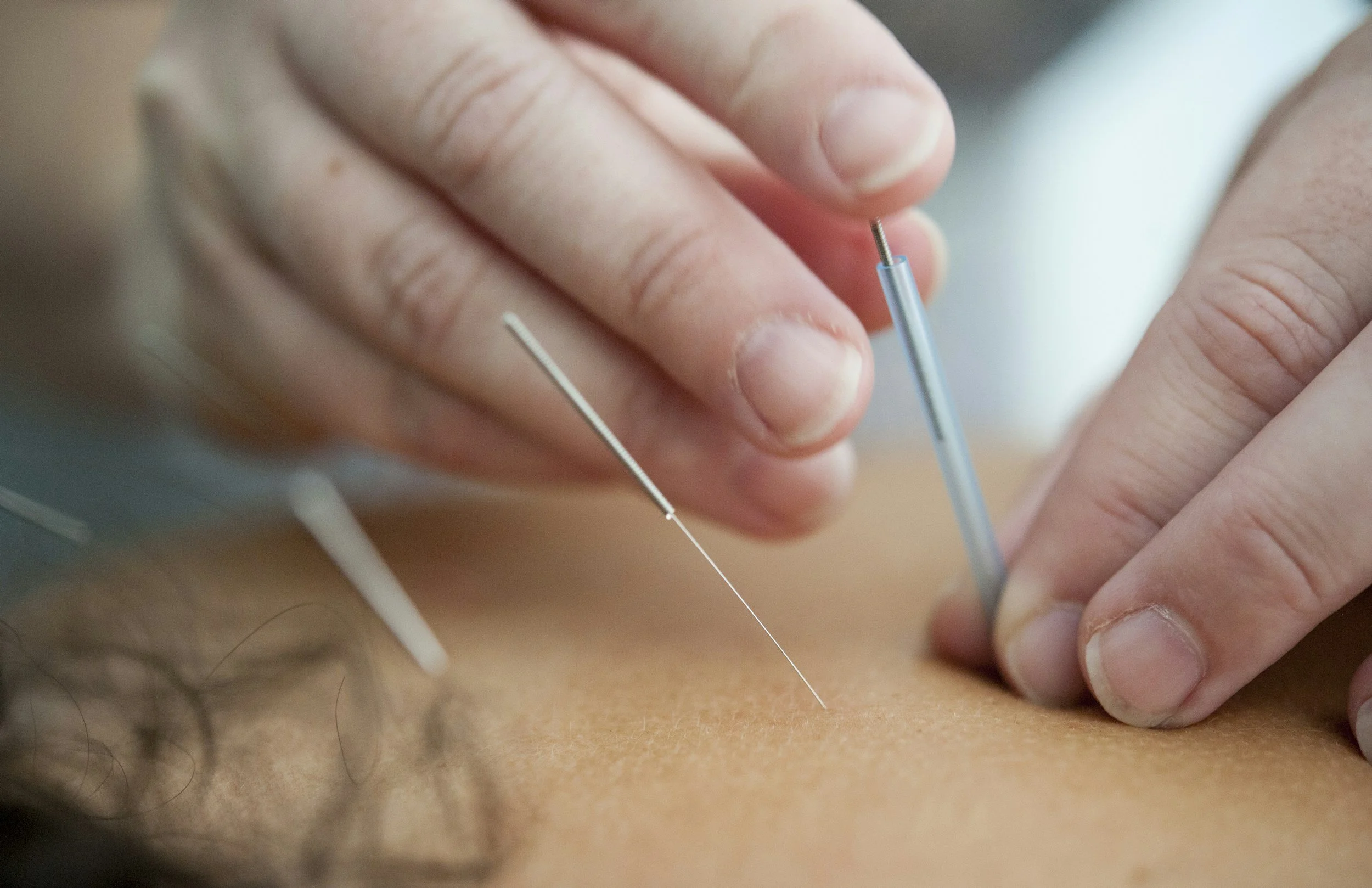 Close-up of a person's hand holding a thin needle or acupuncture tool while another person is lying on a surface, possibly receiving acupuncture treatment.