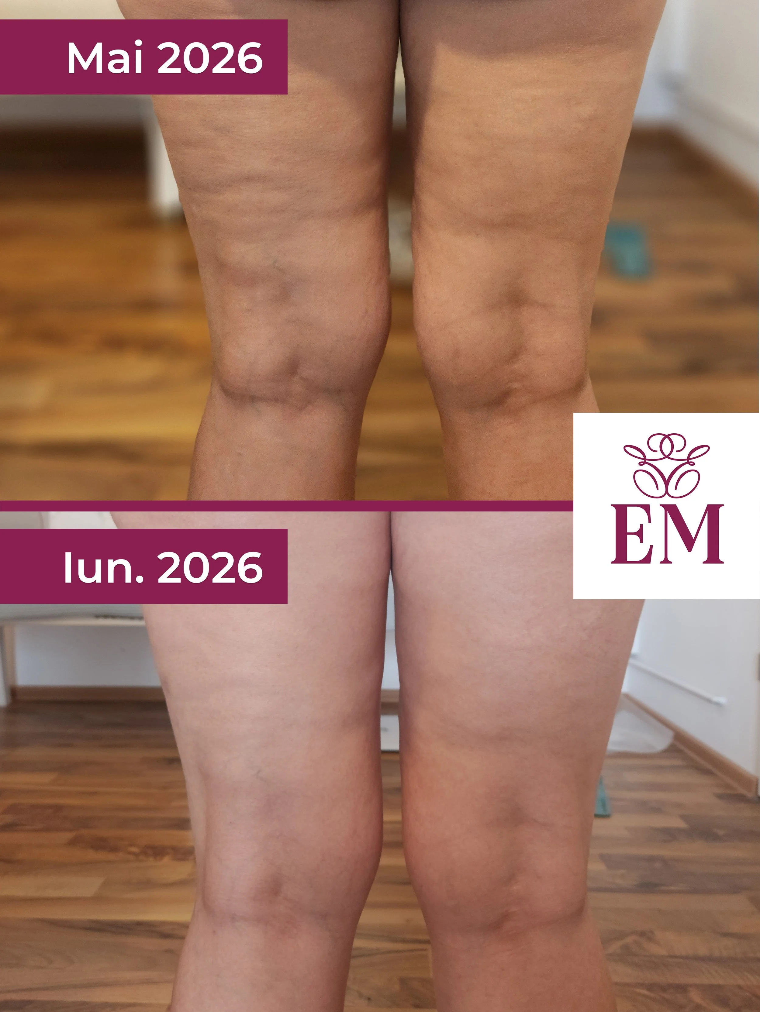 evolutie tratament corporal primex coapse spate
