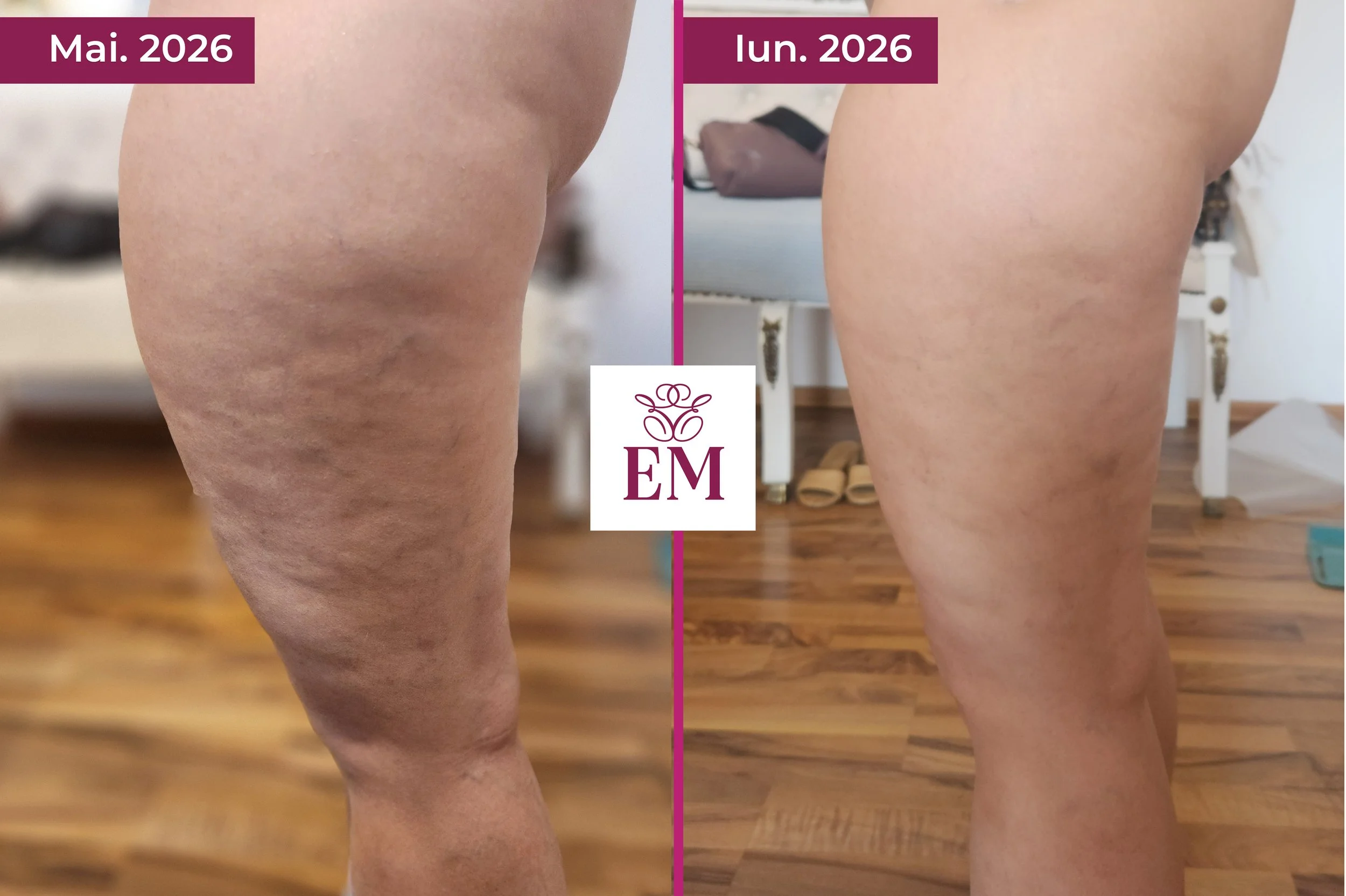 evolutie tratament corporal primex coapse lateral