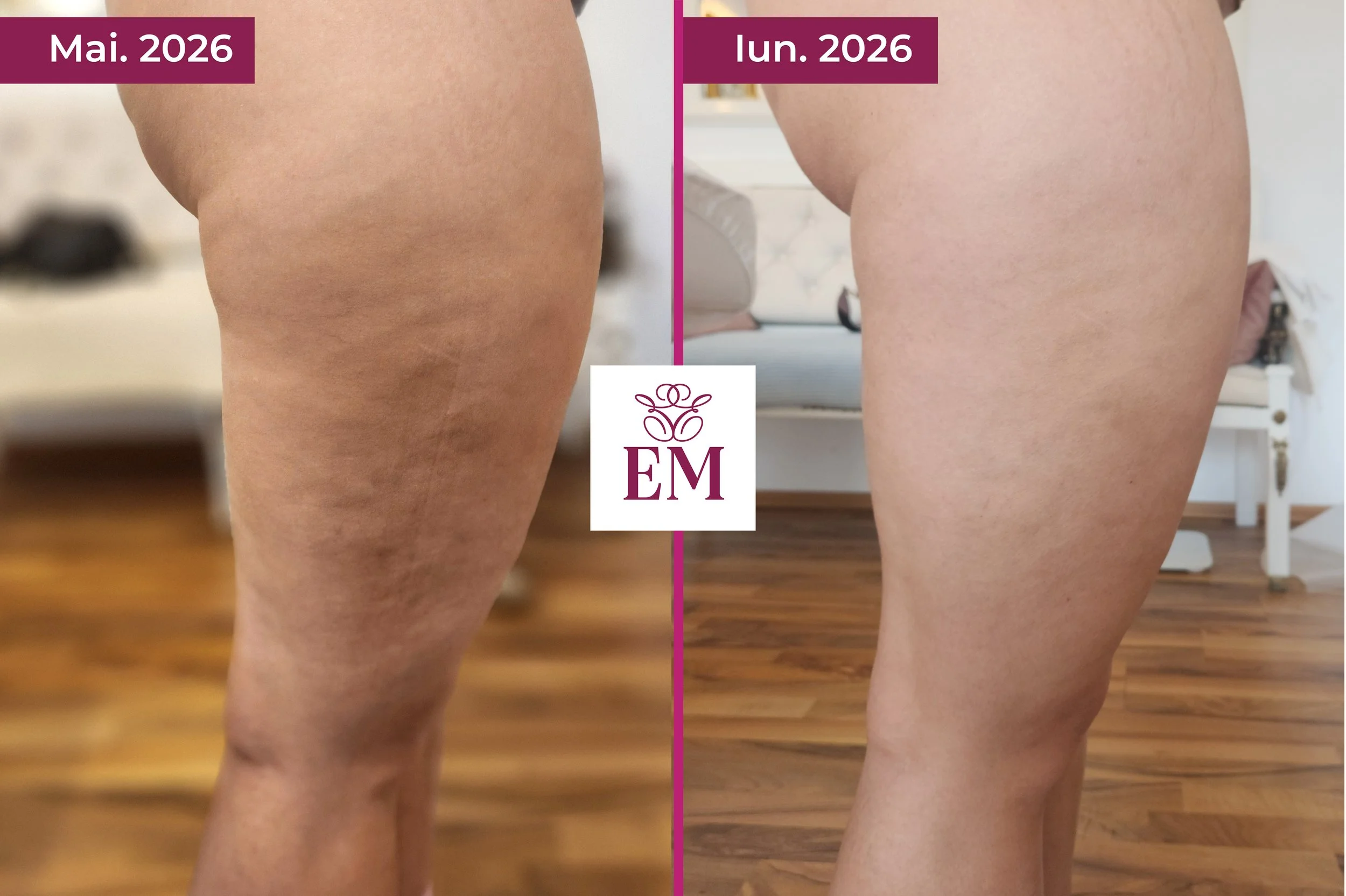 evolutie tratament corporal primex coapse lateral 