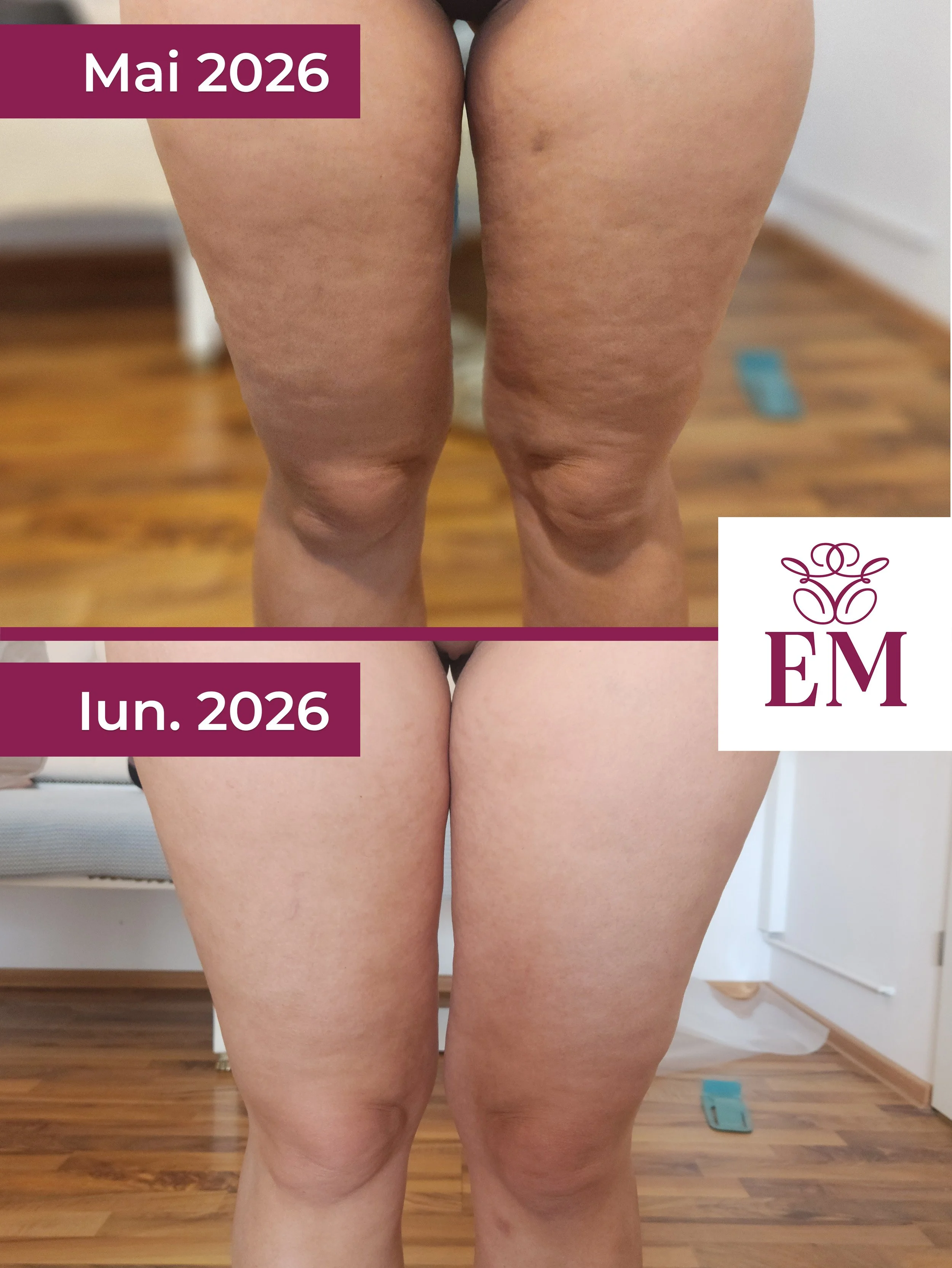 evolutie tratament corporal primex coapse fata