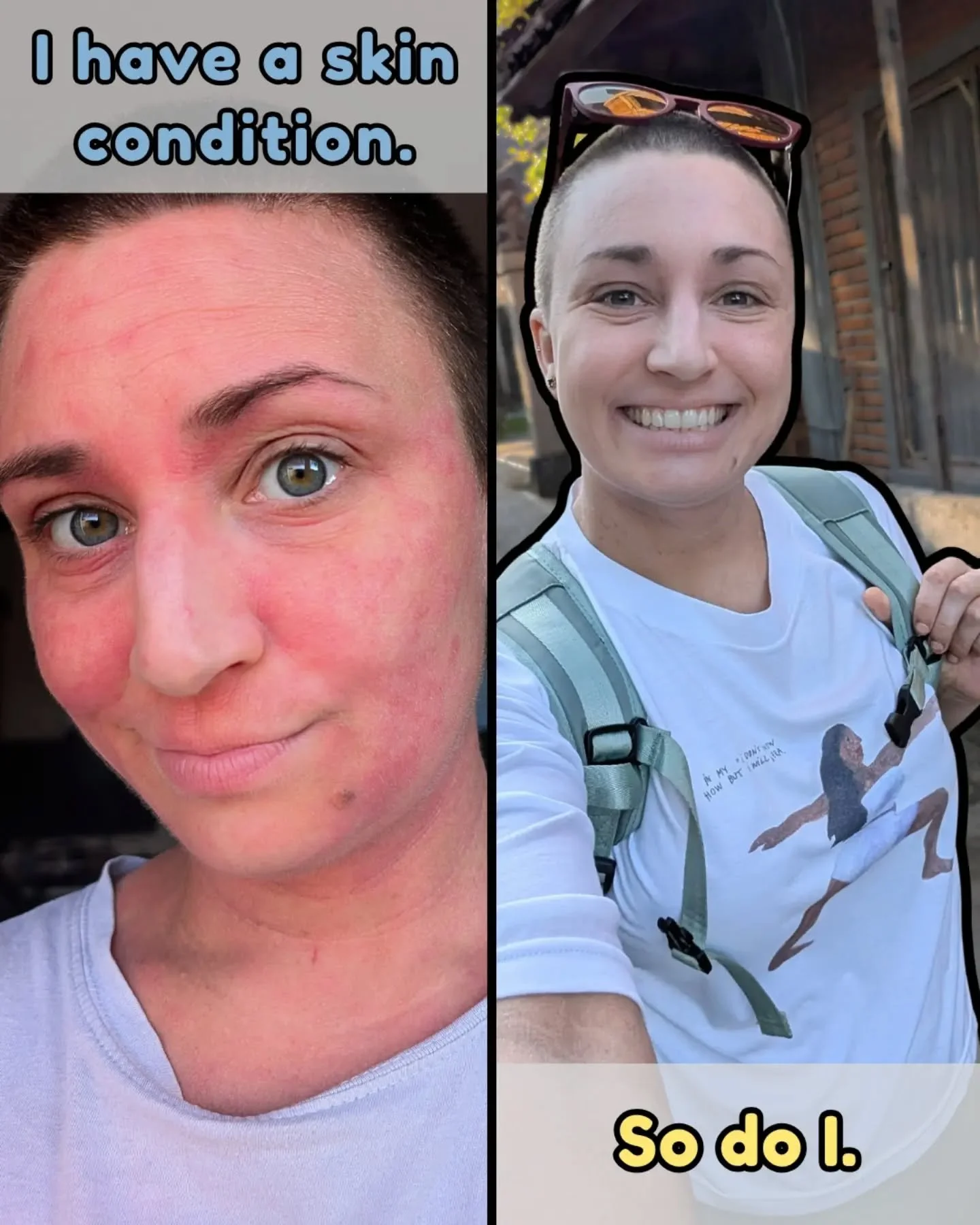 📢 You don&rsquo;t have to look unwell for your experience to be valid. 

✨ Eczema Awareness Week ✨

I want to highlight something I don&rsquo;t think we talk about enough:

📢 We are still living with a skin condition, even when we are NOT visibly f