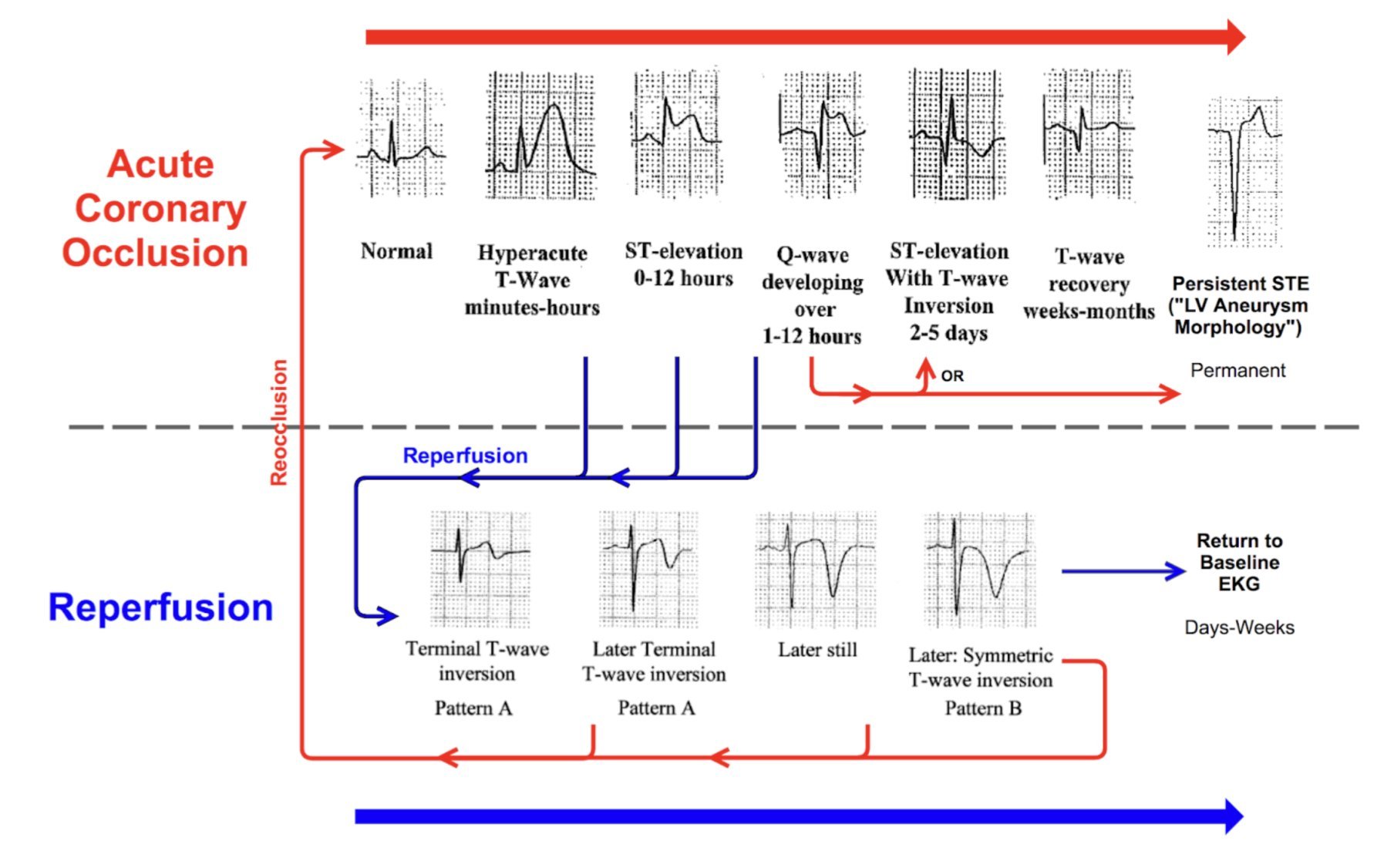 Ecg Infarction Patterns Occlusion Myocardial Infarction (OMI): Importance, Recognition, and ...