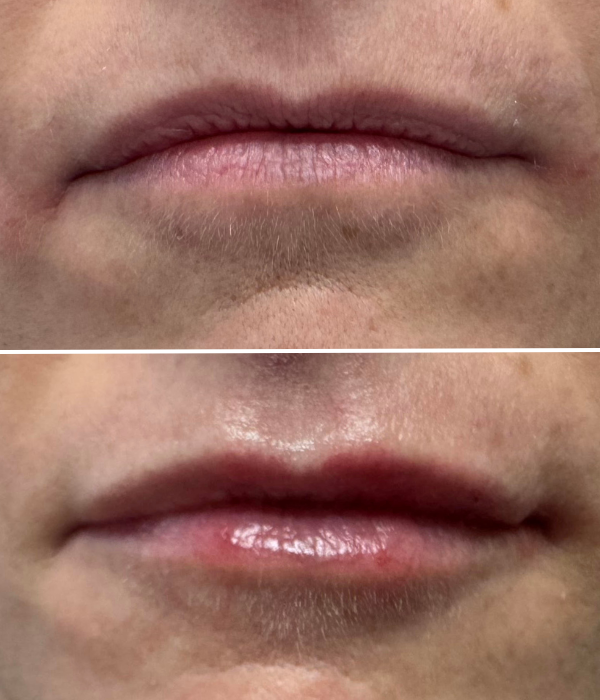 lip before and after.png