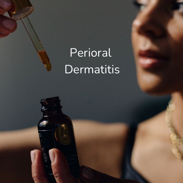 I experienced Perioral Dermatitis in my 20s and 30s and it was distressing. This skin condition commonly presents as a rash around the mouth, characterized by small clusters of papules or red bumps that may also appear near the nose and eyes but pred