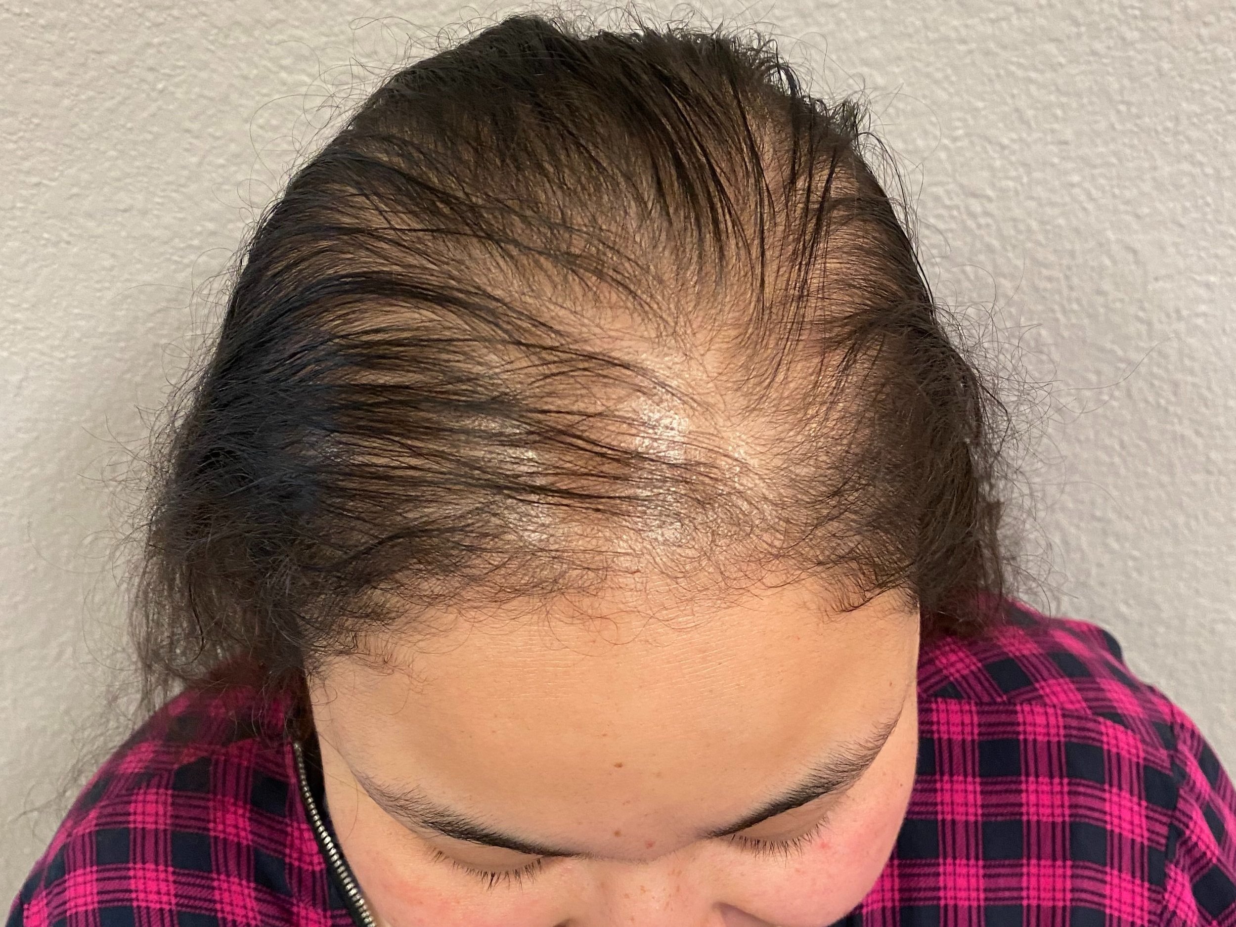 Before Keravive Scalp Treatment with HydraFacial